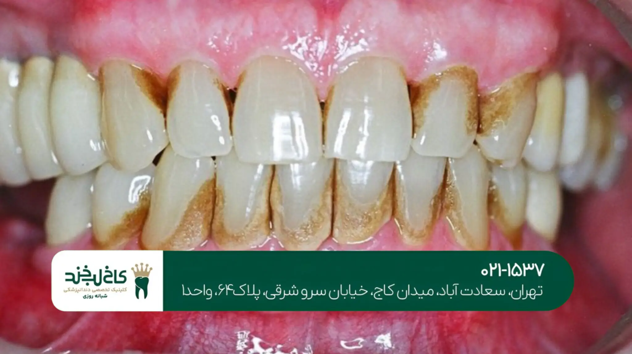 اصلاح طرح لبخند با لمینت دندان