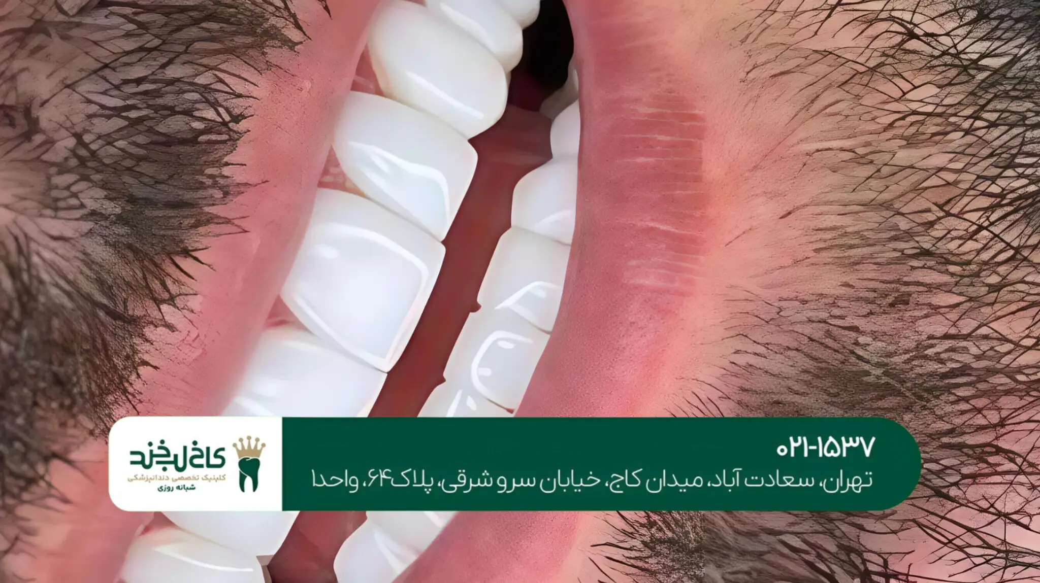 اصلاح طرح لبخند با لمینت دندان