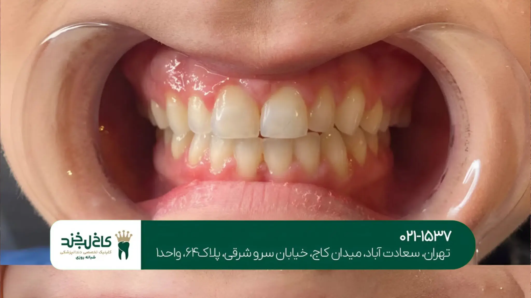 اصلاح طرح لبخند با لمینت دندان