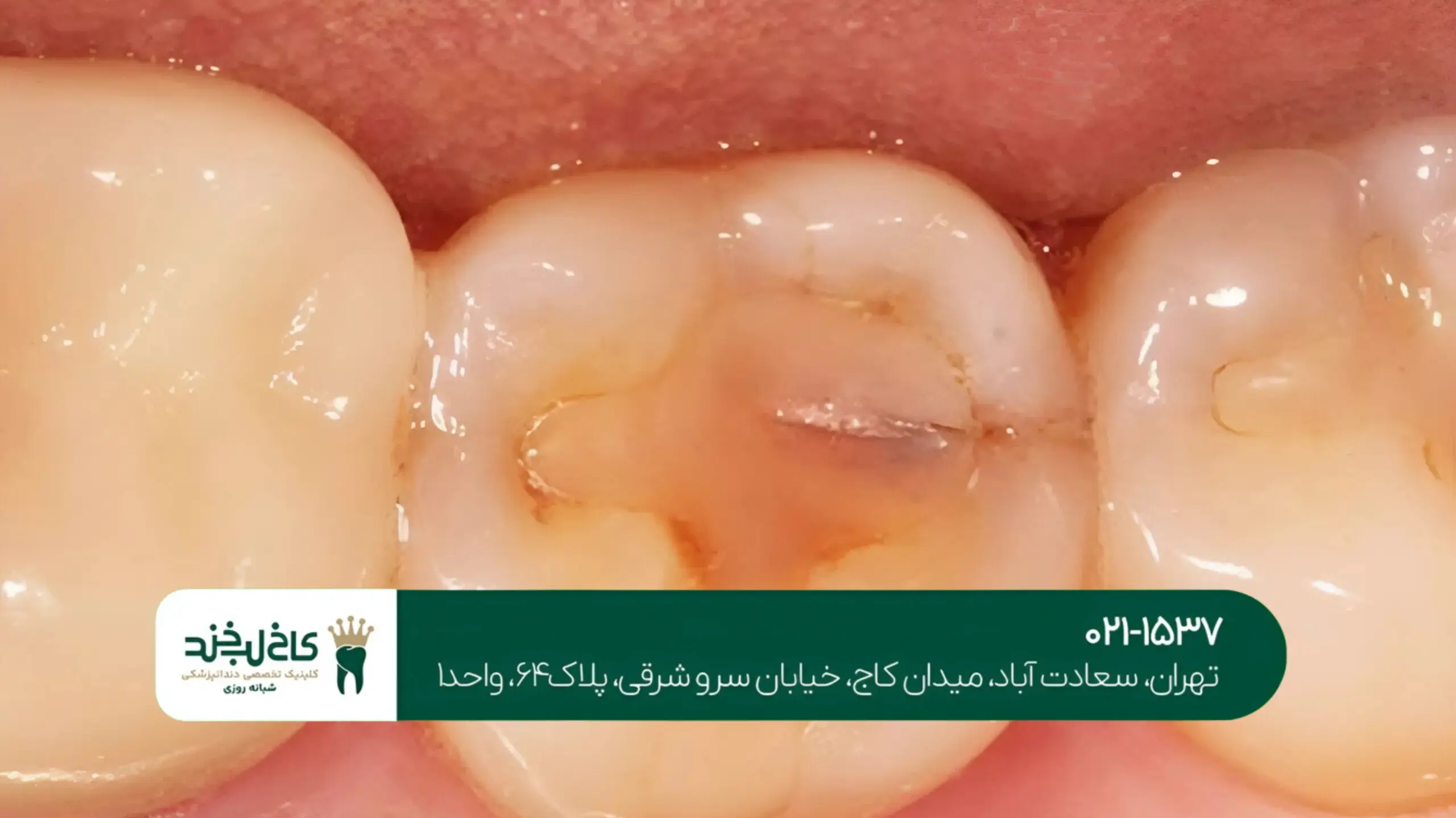 ایمپلنت دندان اقساطی در تهران