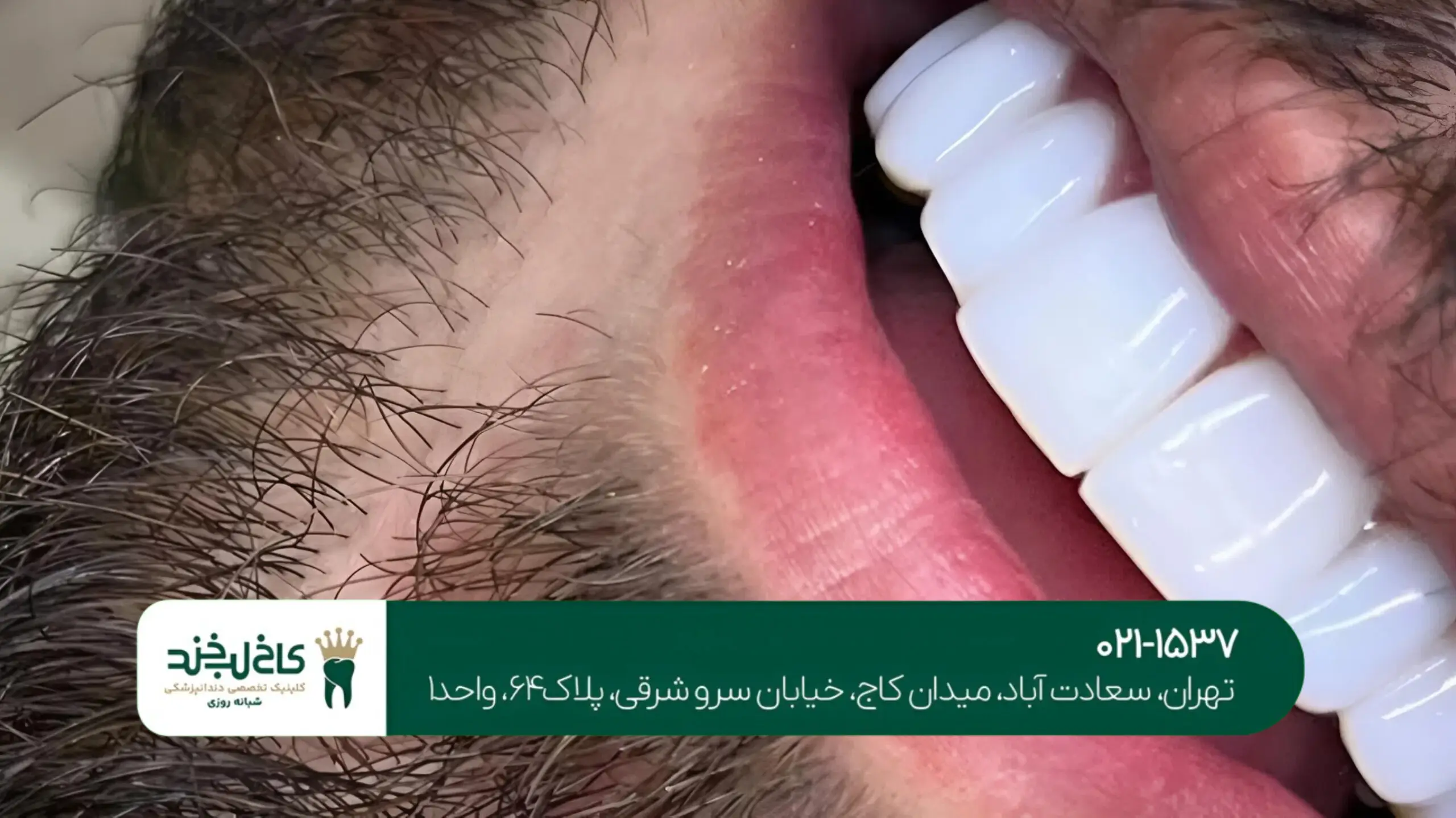 ایمپلنت دندان اقساطی در تهران