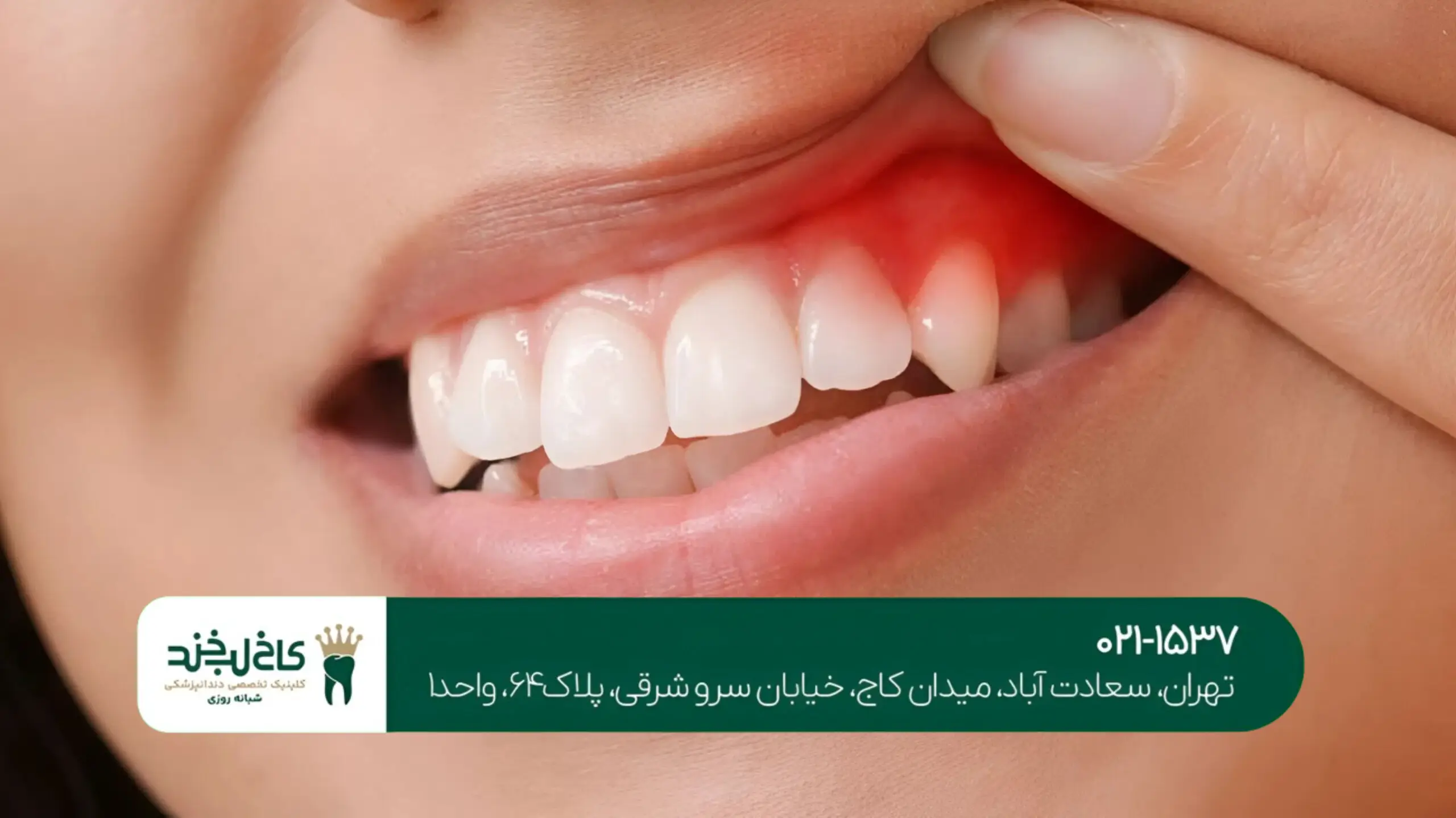 ایمپلنت دندان اقساطی در تهران