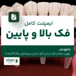 ایمپلنت کامل فک بالا و پایین