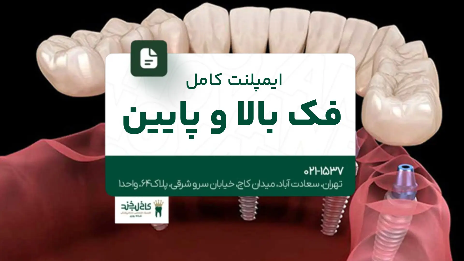 ایمپلنت کامل فک بالا و پایین