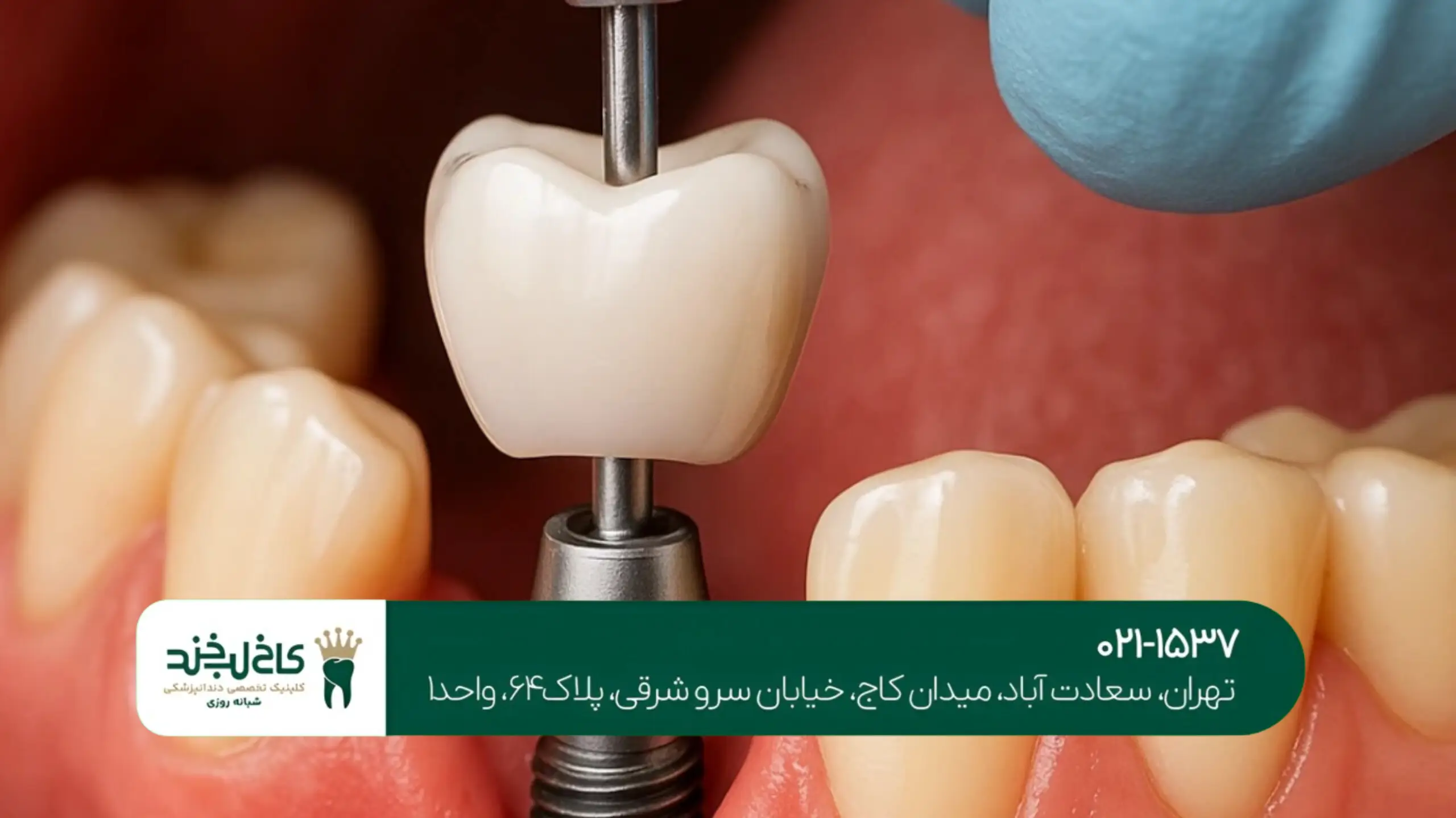 ایمپلنت کامل فک بالا و پایین