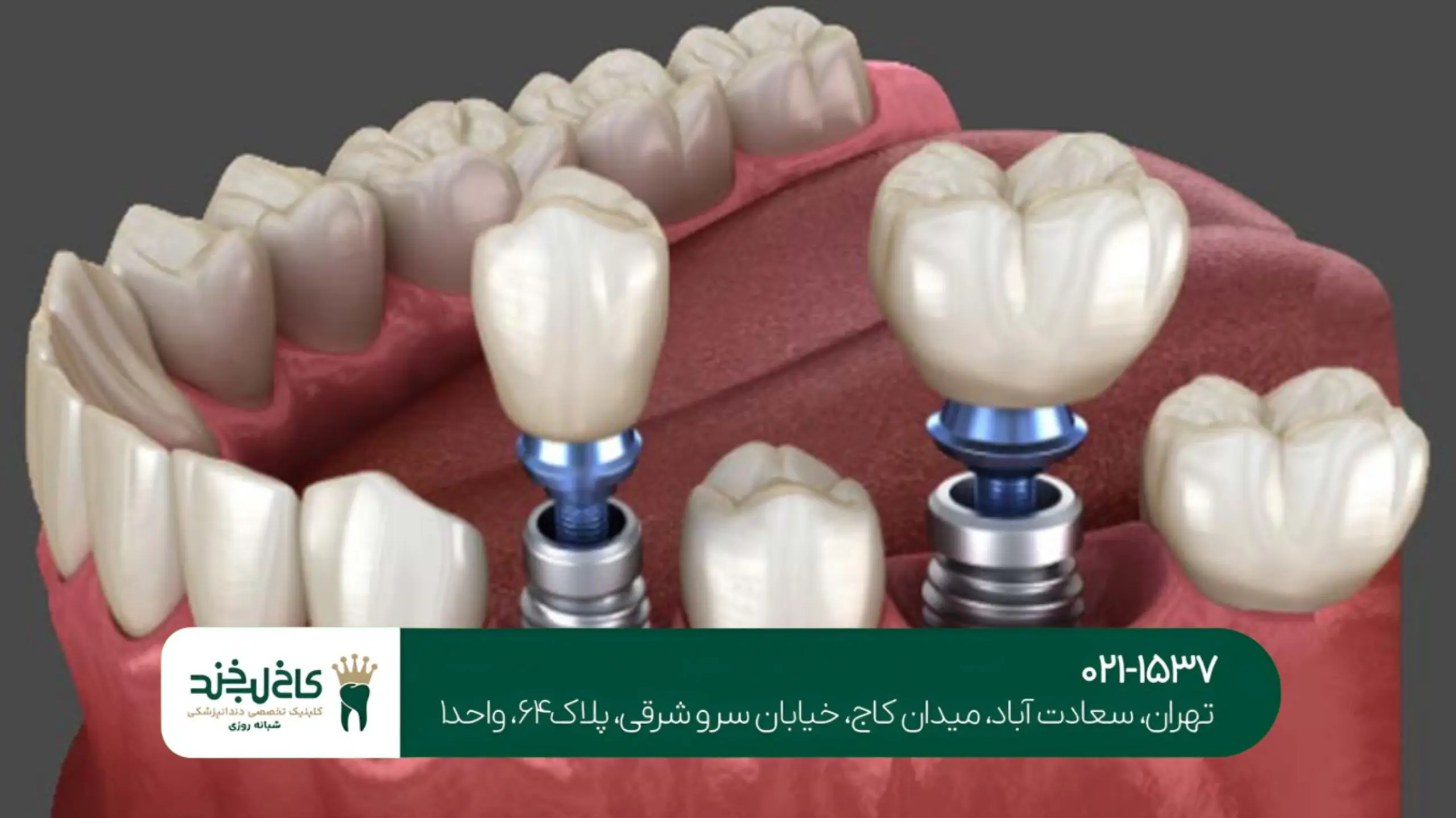 ایمپلنت کامل فک بالا و پایین