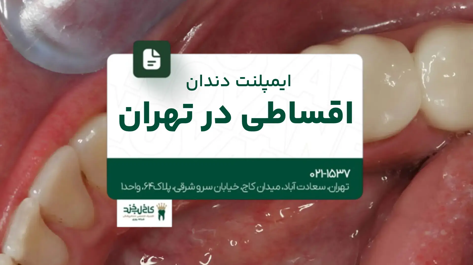 ایمپلنت دندان اقساطی در تهران
