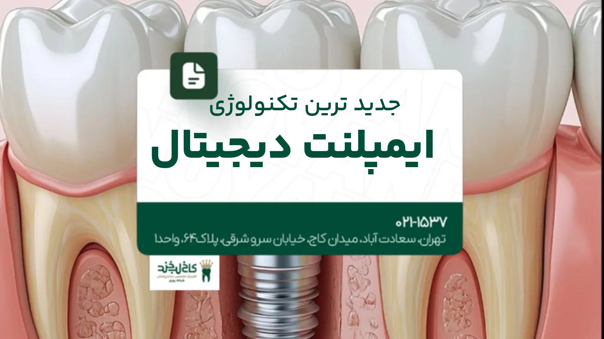 جدیدترین تکنولوژی ایمپلنت دیجیتال