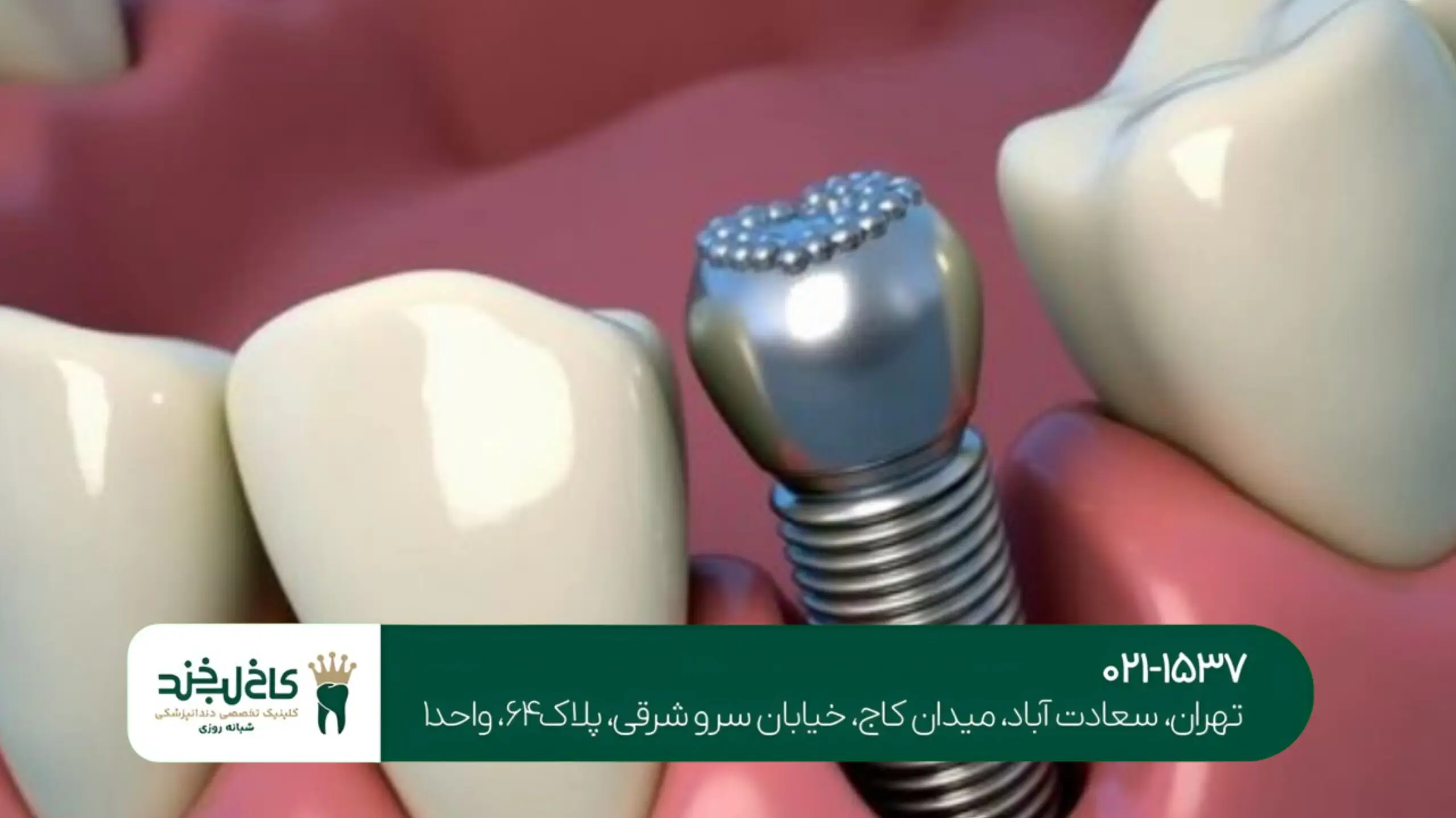 جدیدترین تکنولوژی ایمپلنت دیجیتال