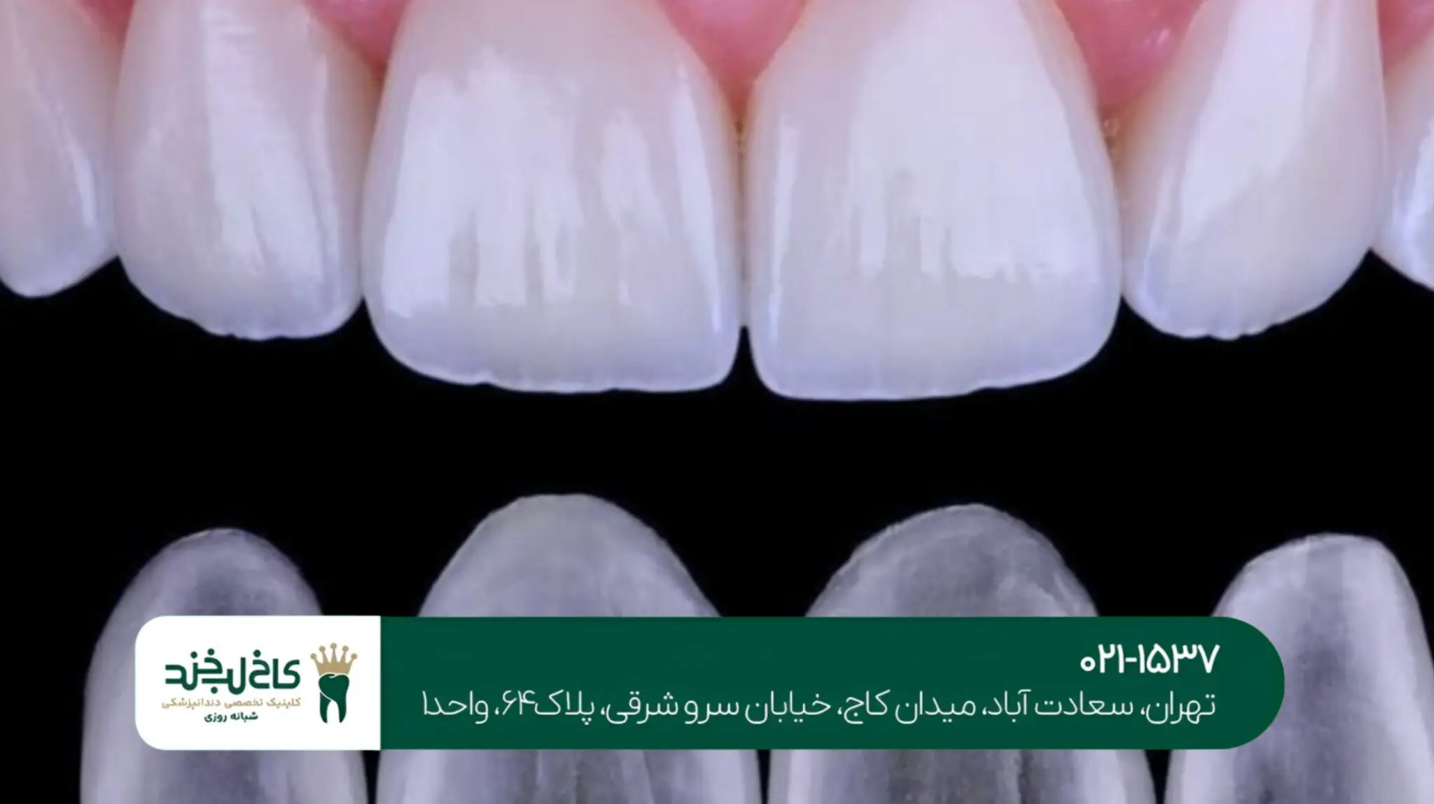 جدیدترین تکنولوژی ایمپلنت دیجیتال