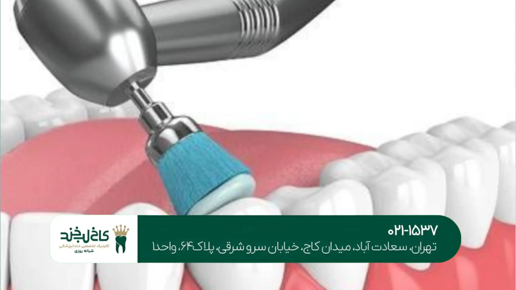 جراحی دندان عقل در کلینیک تخصصی