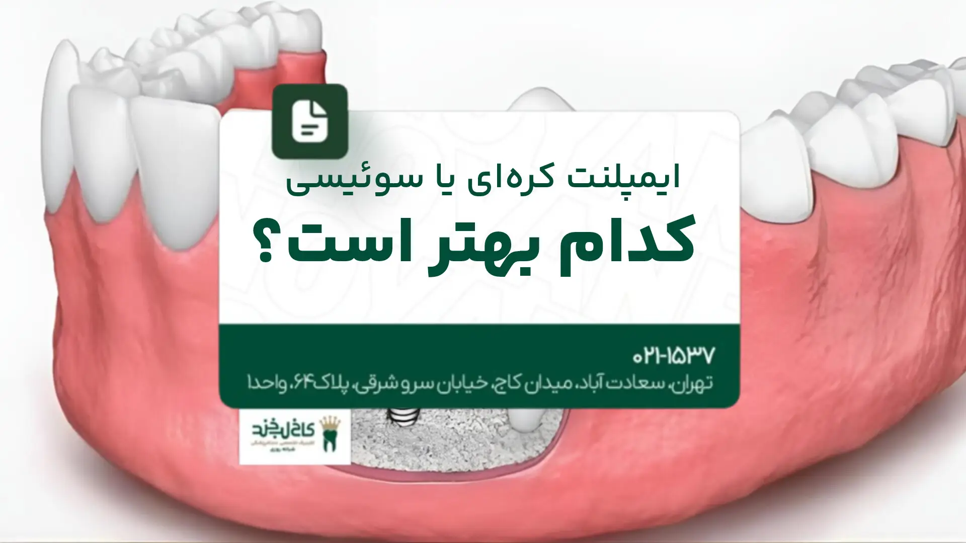  ایمپلنت کره‌ای یا سوئیسی؛ کدام بهتر است؟