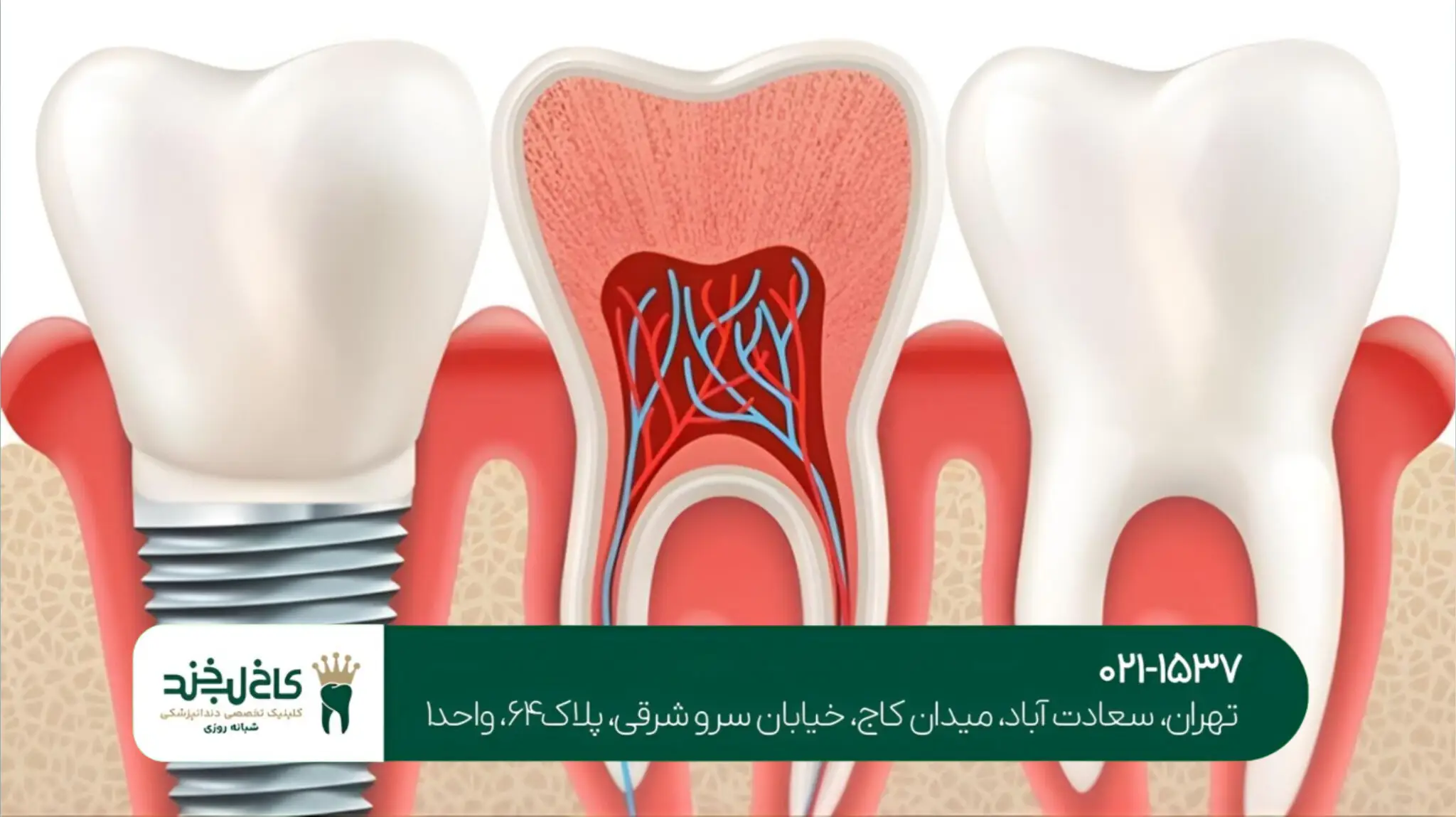  ایمپلنت کره‌ای یا سوئیسی؛ کدام بهتر است؟