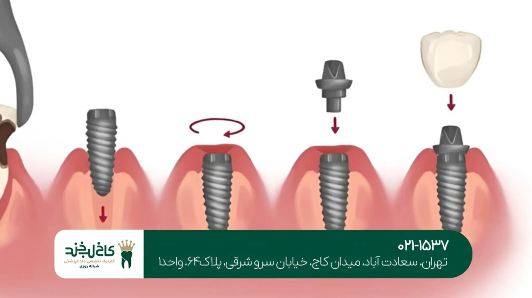  ایمپلنت کره‌ای یا سوئیسی؛ کدام بهتر است؟