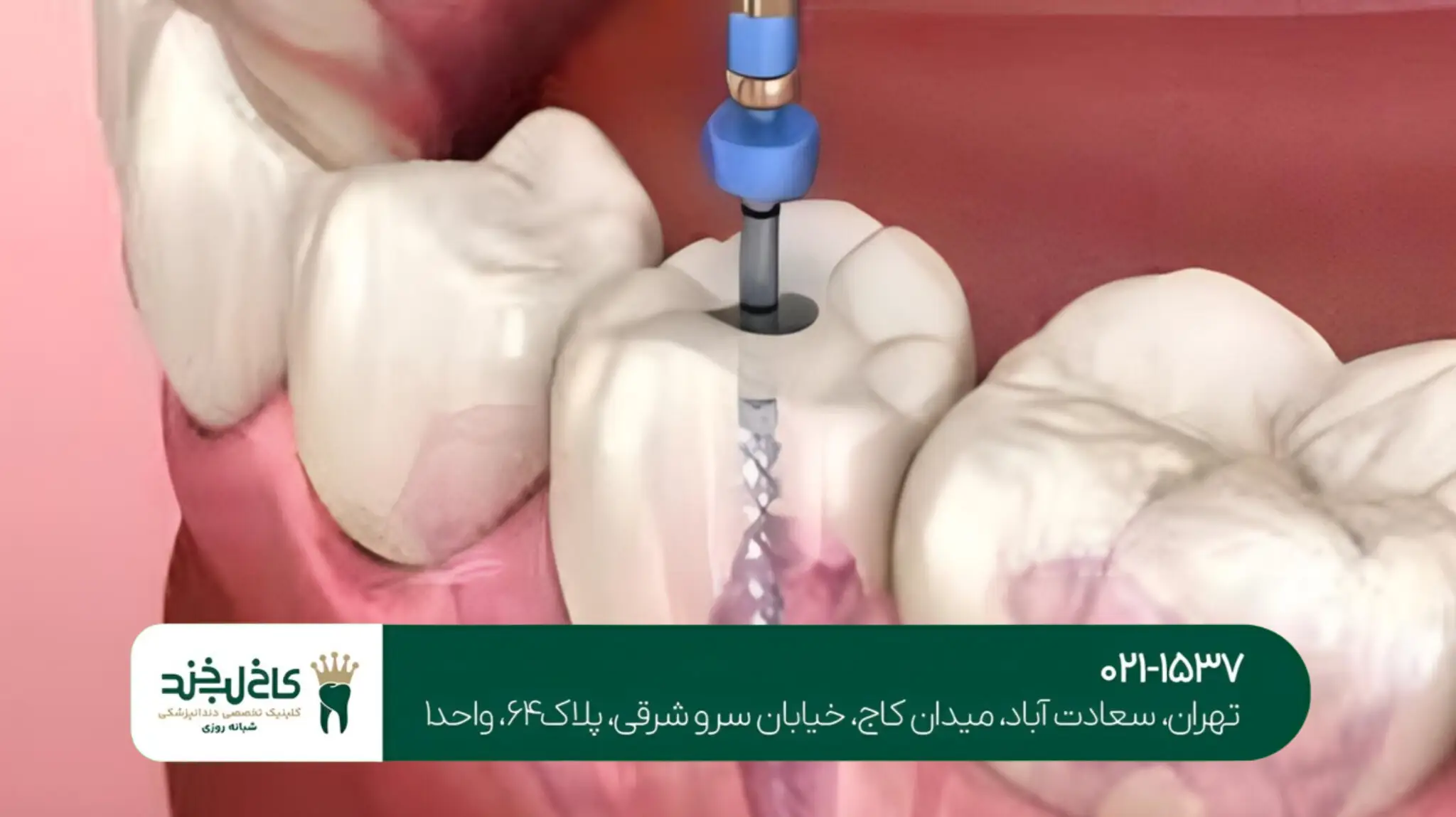  ایمپلنت کره‌ای یا سوئیسی؛ کدام بهتر است؟