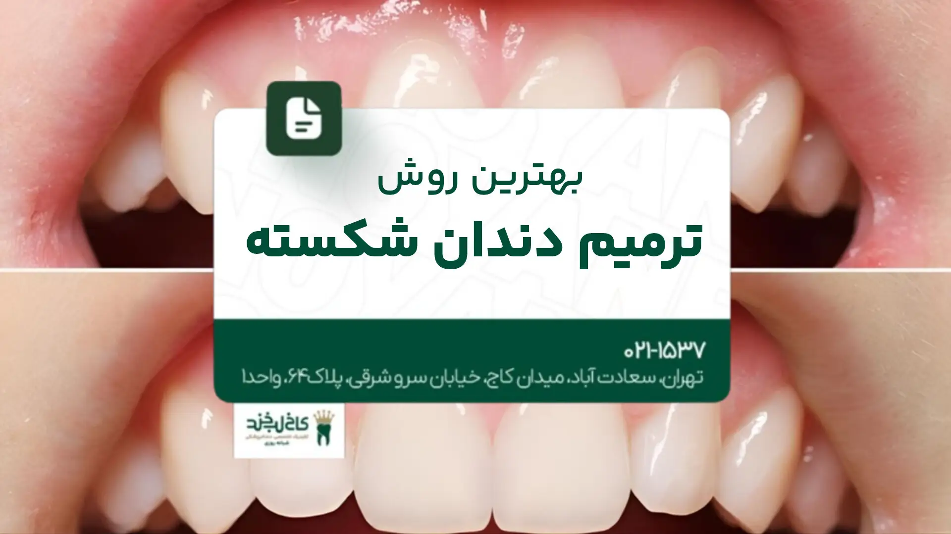 بهترین روش ترمیم دندان شکسته