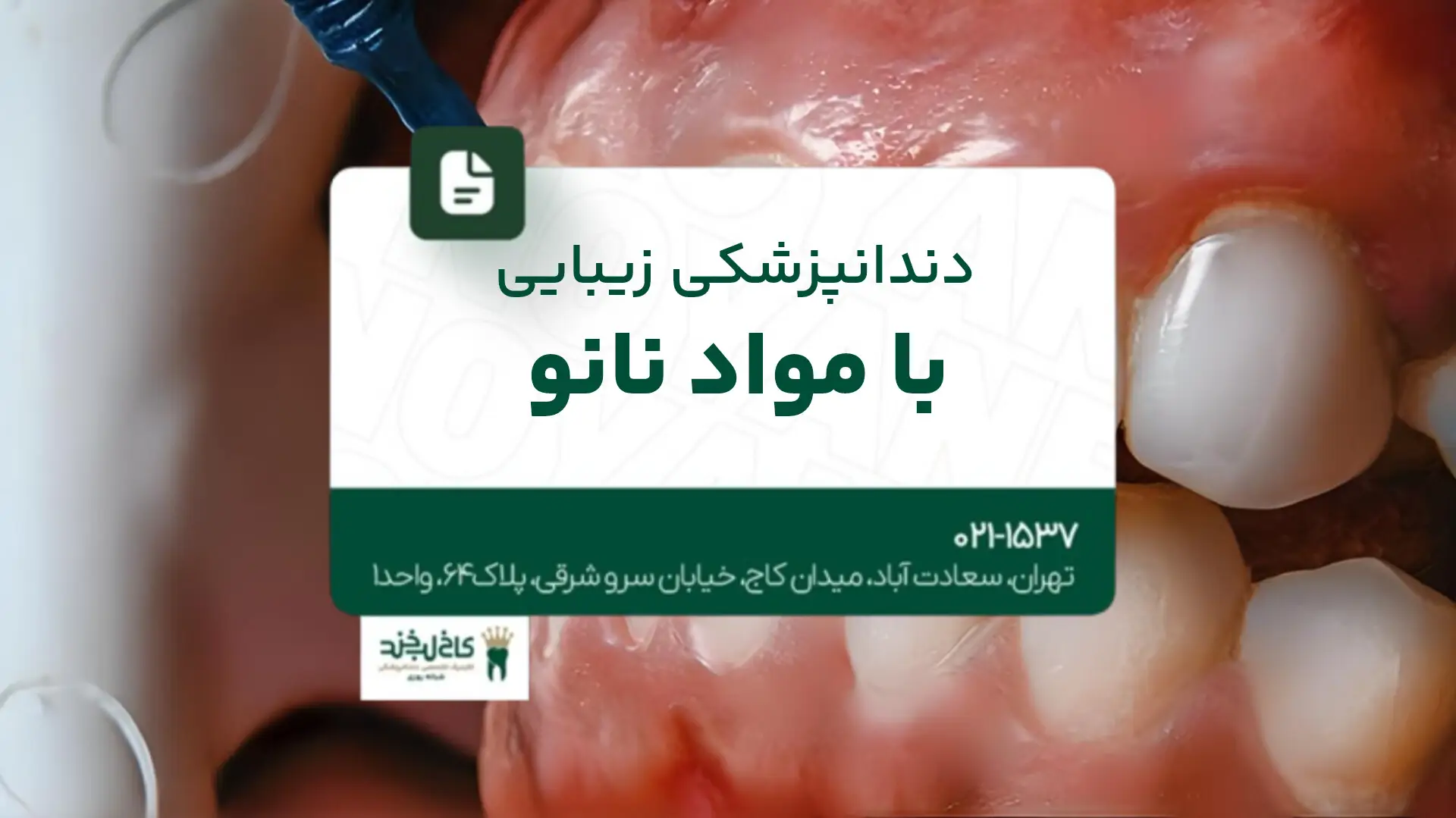 دندانپزشکی زیبایی با مواد نانو