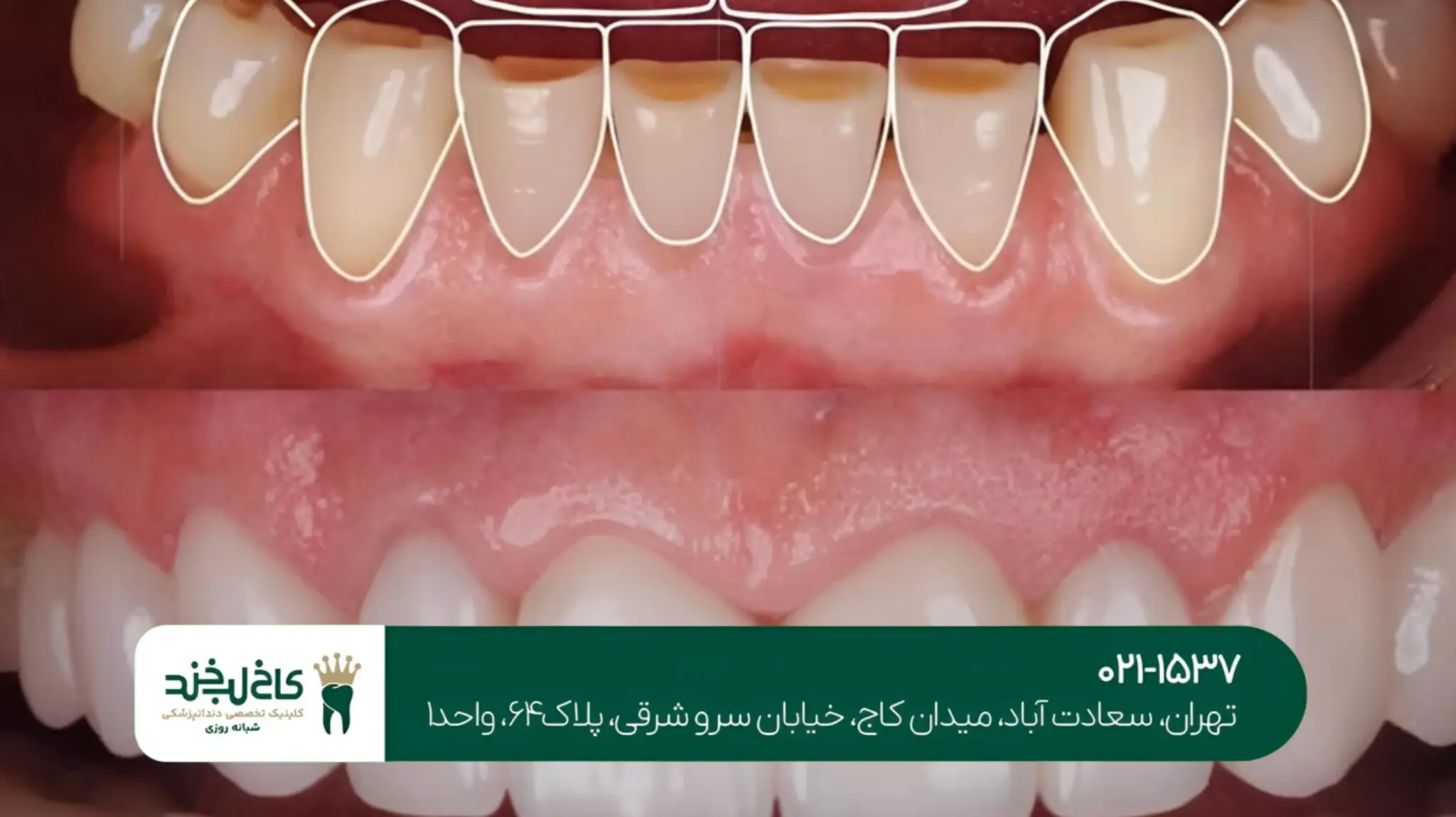 دندانپزشکی زیبایی با مواد نانو