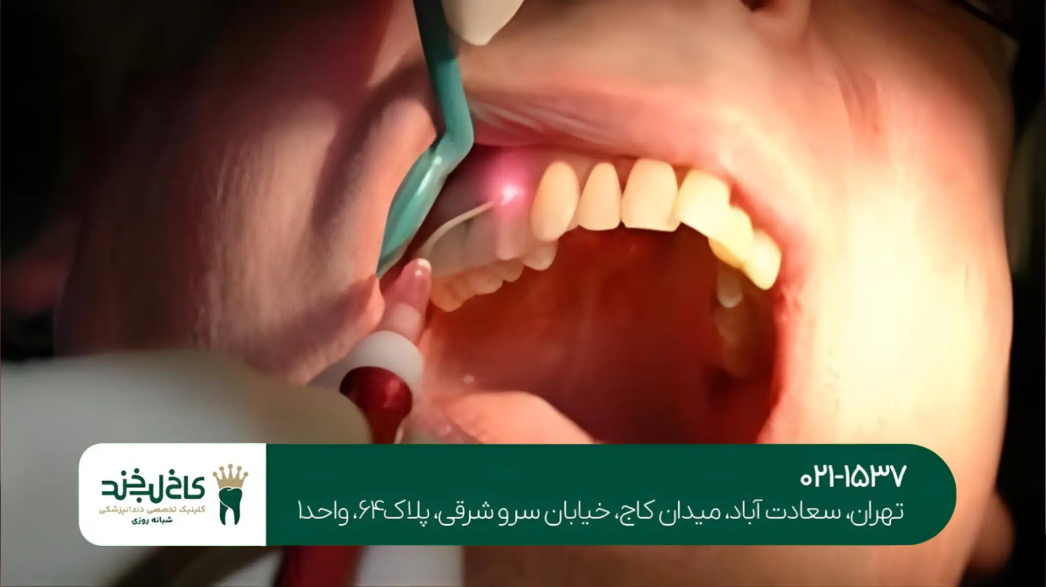 بهترین روش ترمیم دندان شکسته