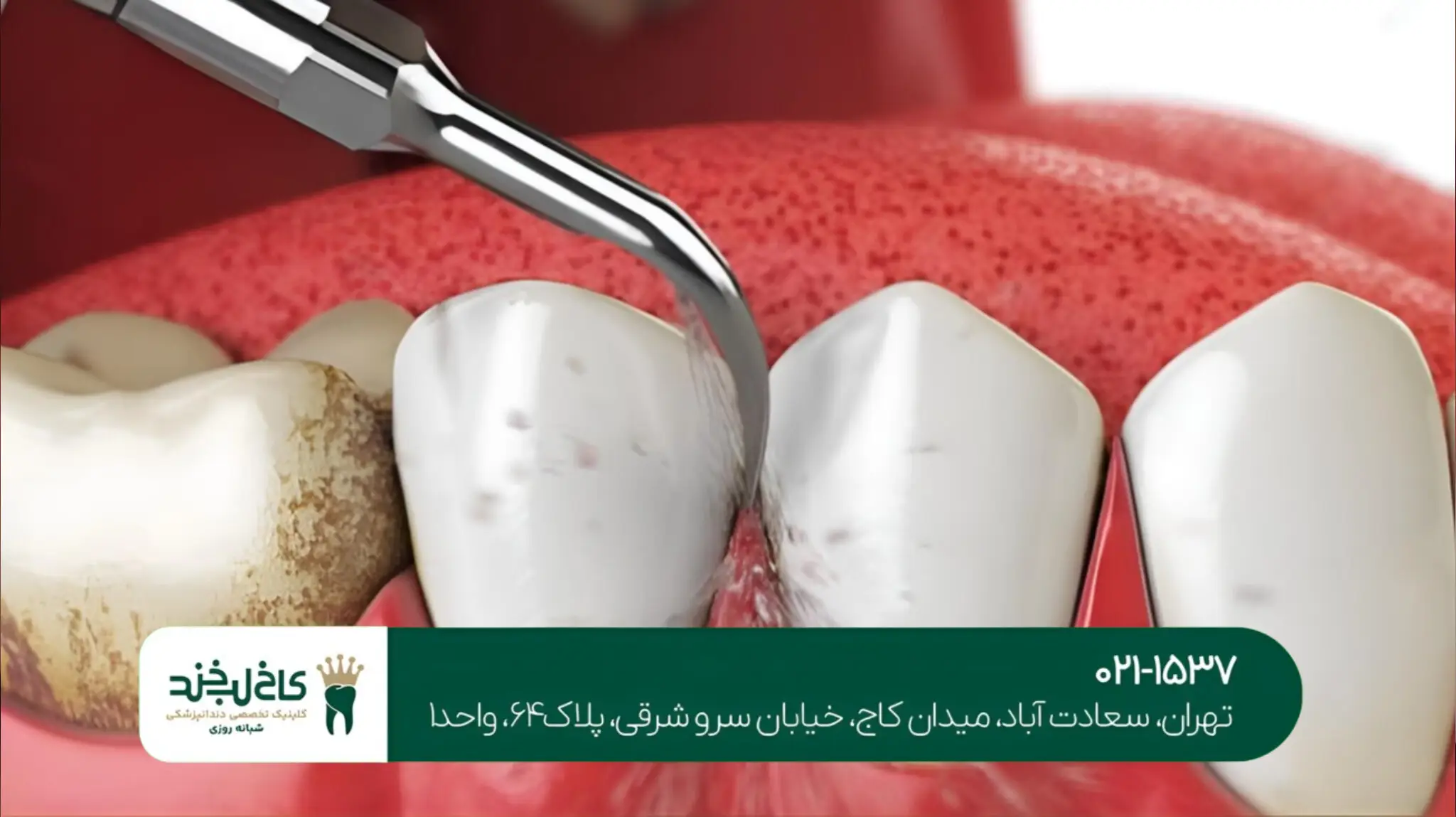 بهترین روش ترمیم دندان شکسته