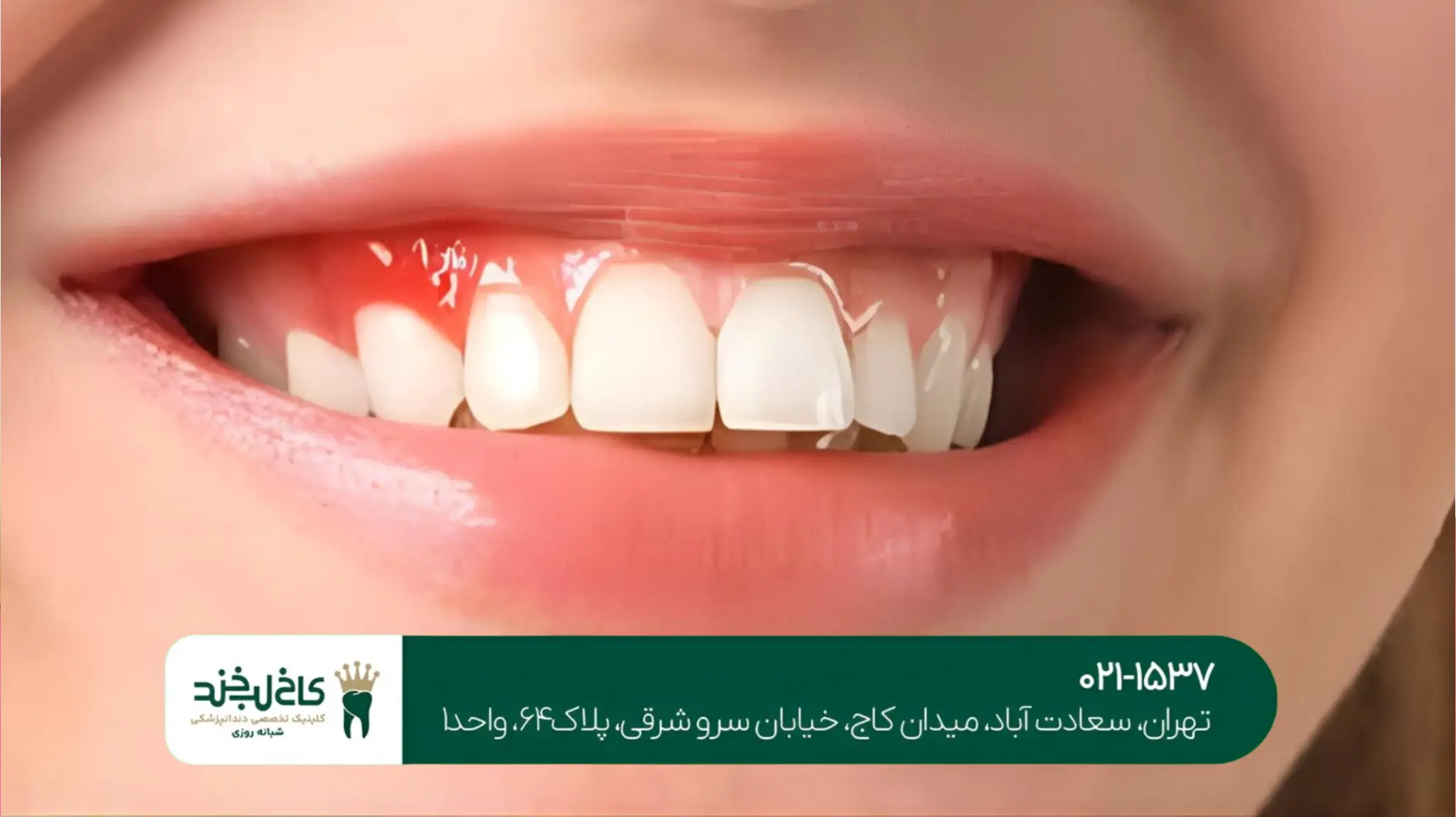 درمان عفونت بعد از ایمپلنت دندان