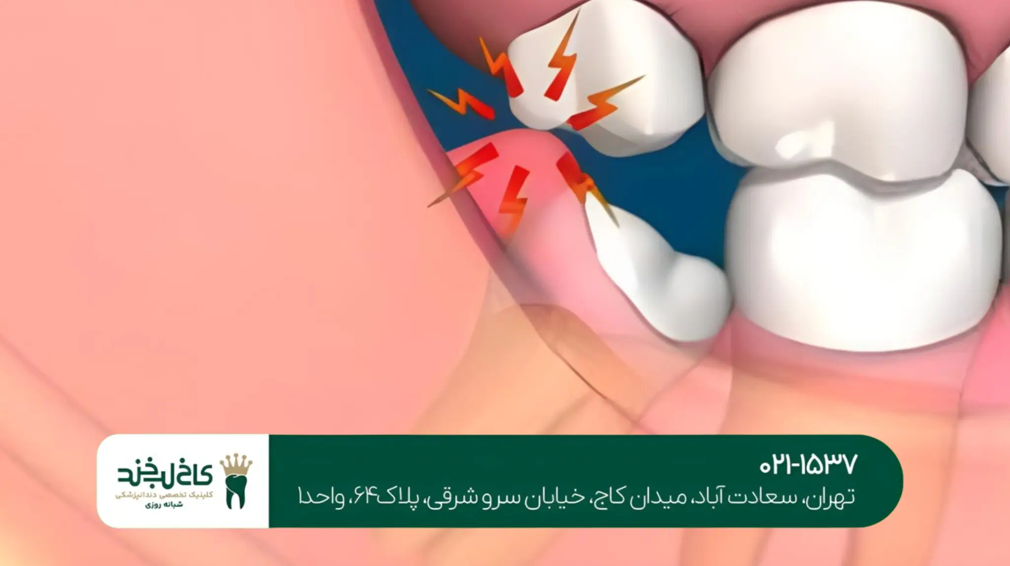 درمان عفونت بعد از ایمپلنت دندان