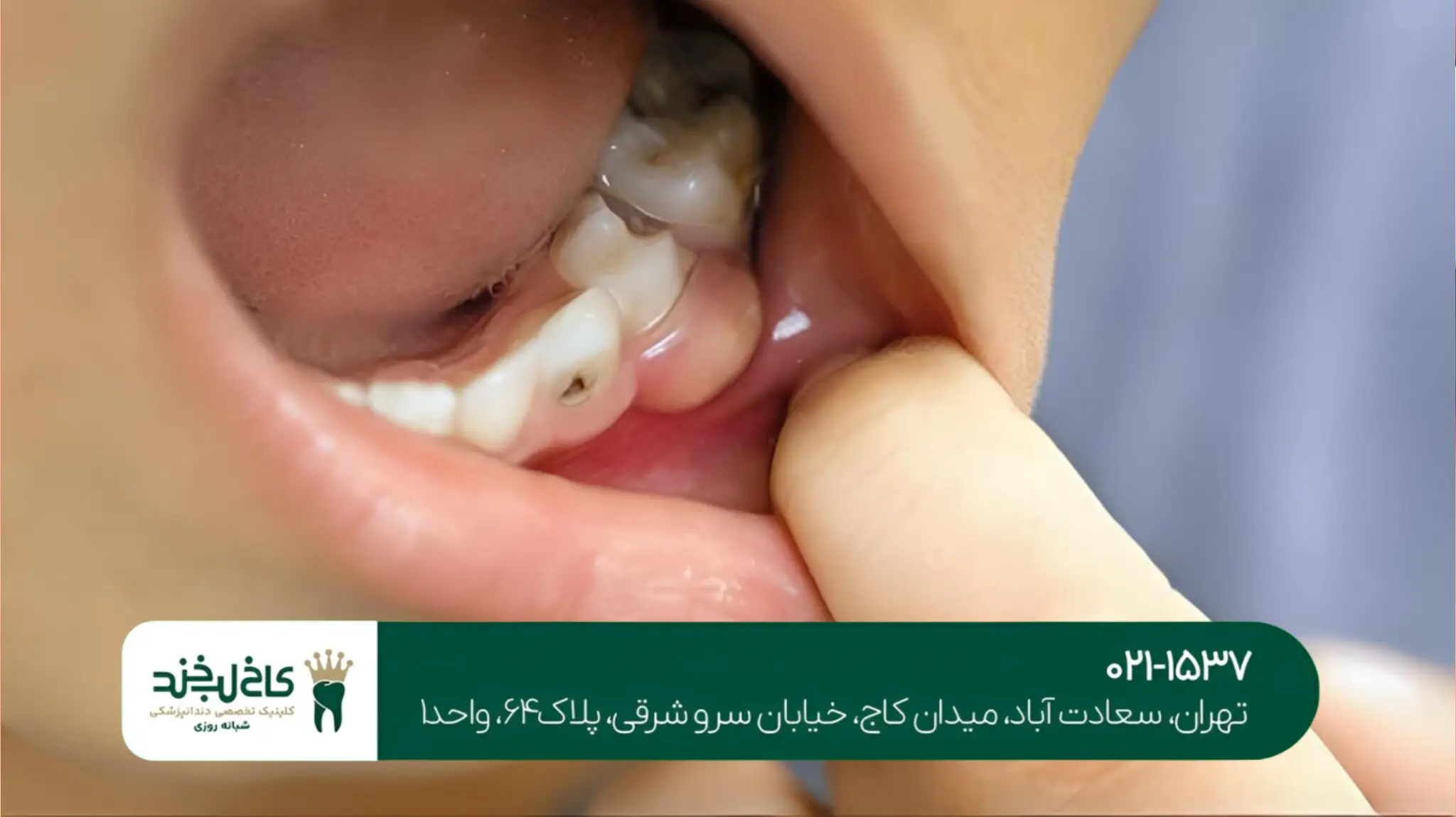 درمان عفونت بعد از ایمپلنت دندان