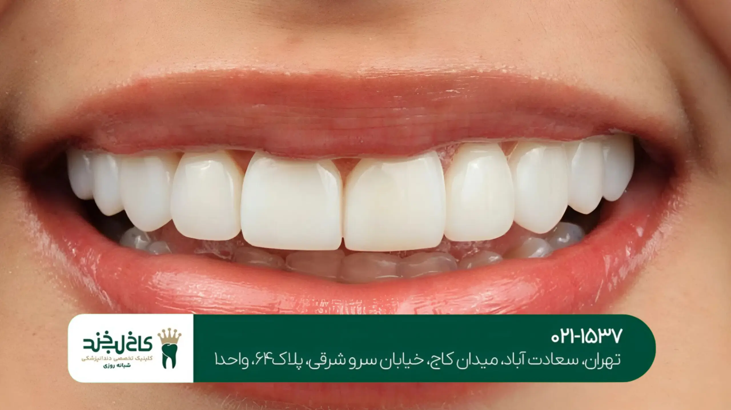 بهترین دندانپزشک برای لمینت سرامیکی