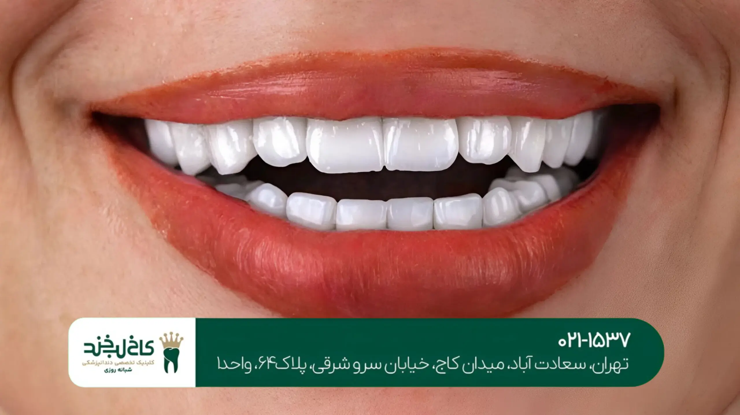 بهترین دندانپزشک برای لمینت سرامیکی