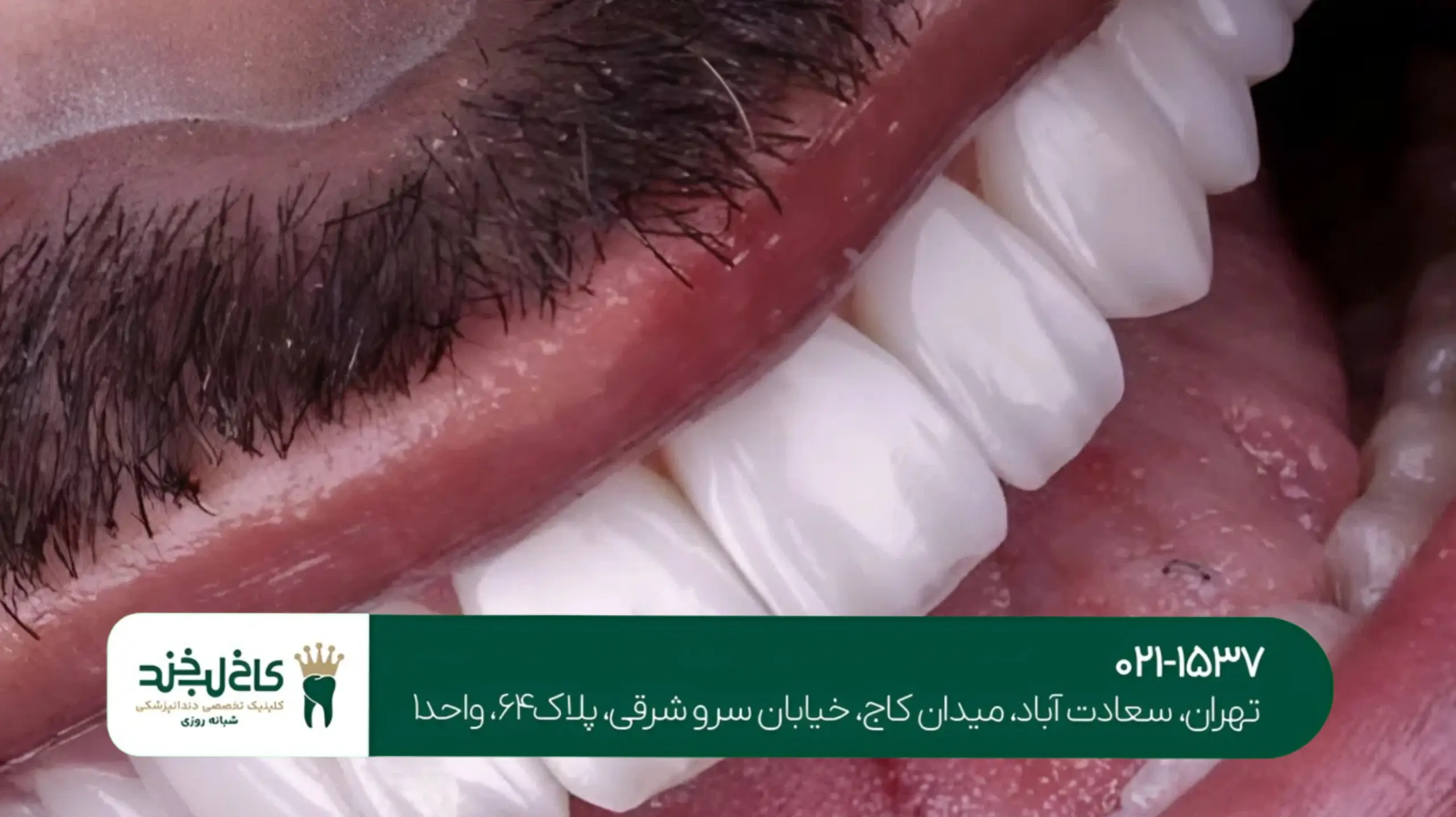 بهترین دندانپزشک برای لمینت سرامیکی