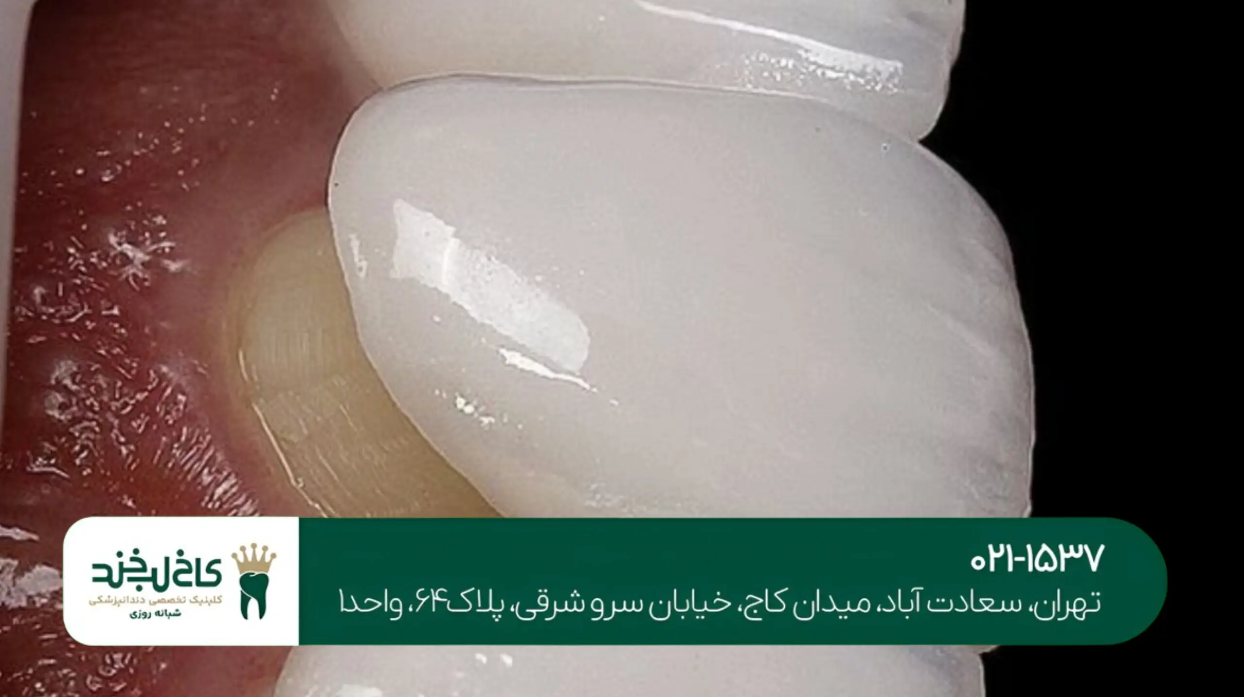 قیمت کامپوزیت دندان طبیعی در تهران