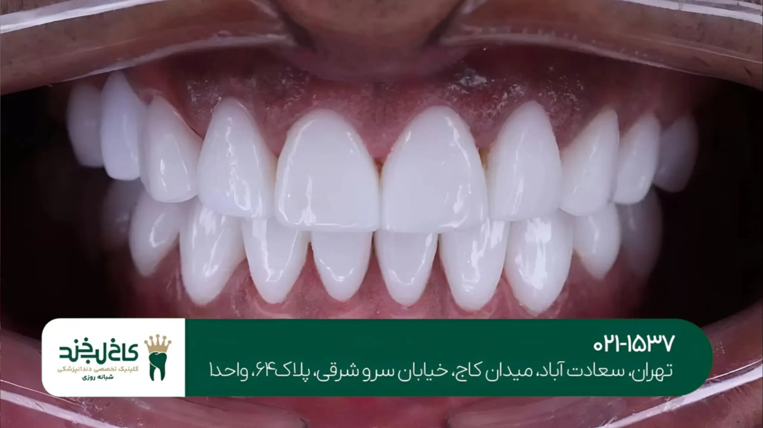 قیمت کامپوزیت دندان طبیعی در تهران