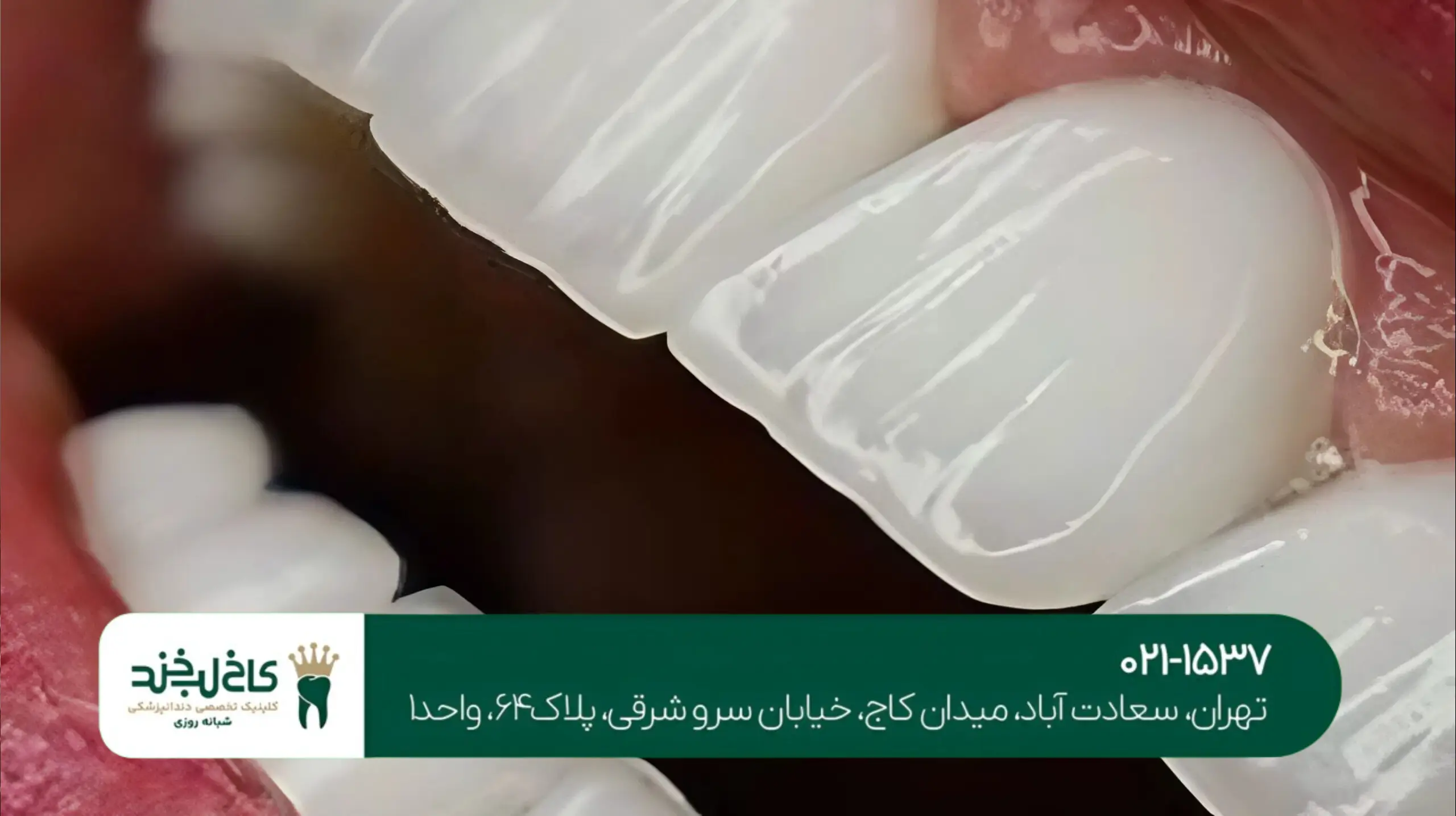 قیمت کامپوزیت دندان طبیعی در تهران