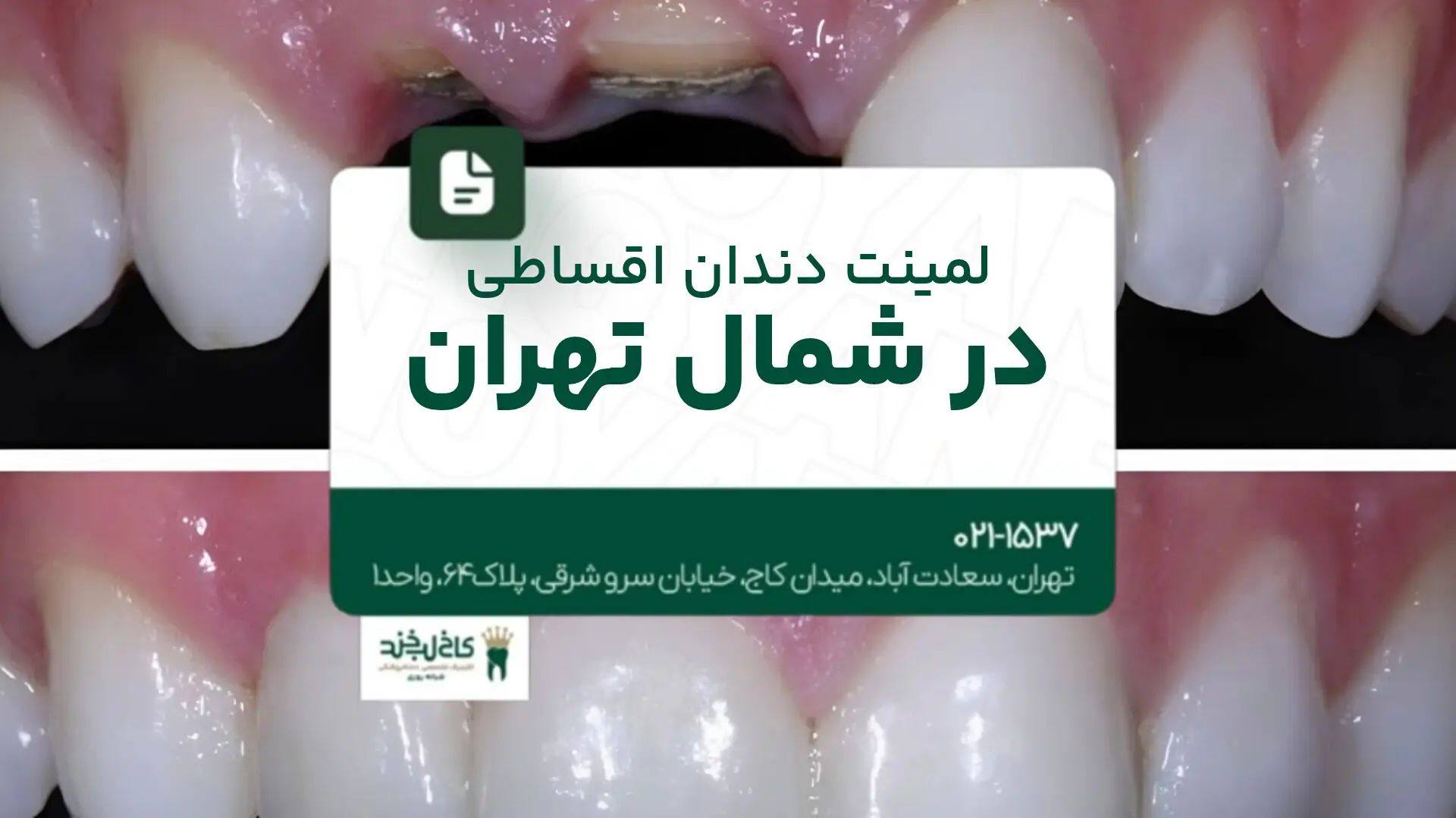 لمینت دندان اقساطی در شمال تهران