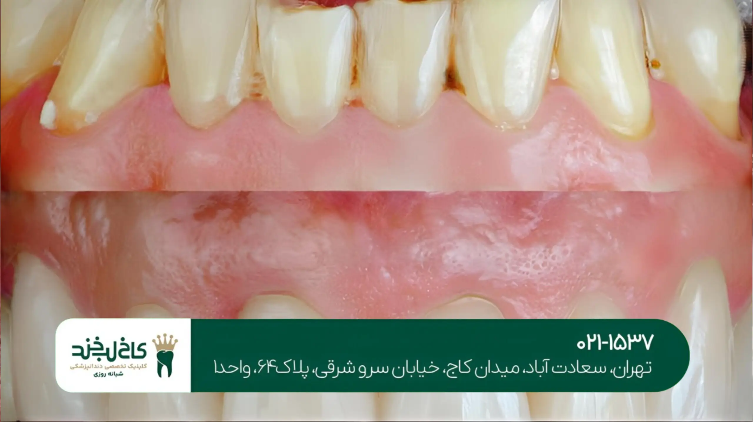 لمینت دندان اقساطی در شمال تهران