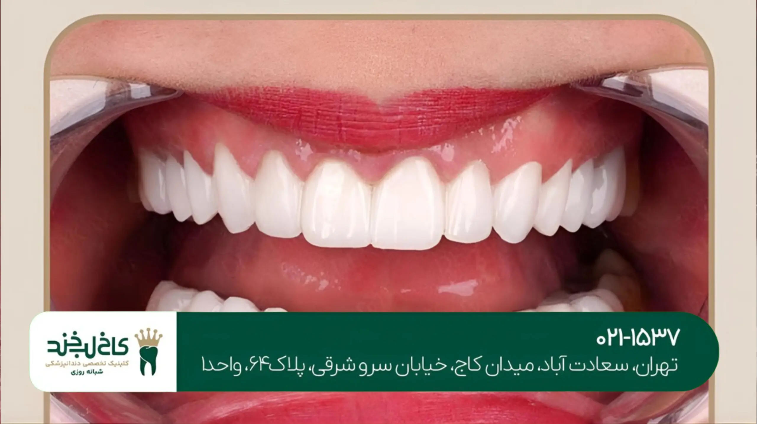 لمینت دندان اقساطی در شمال تهران