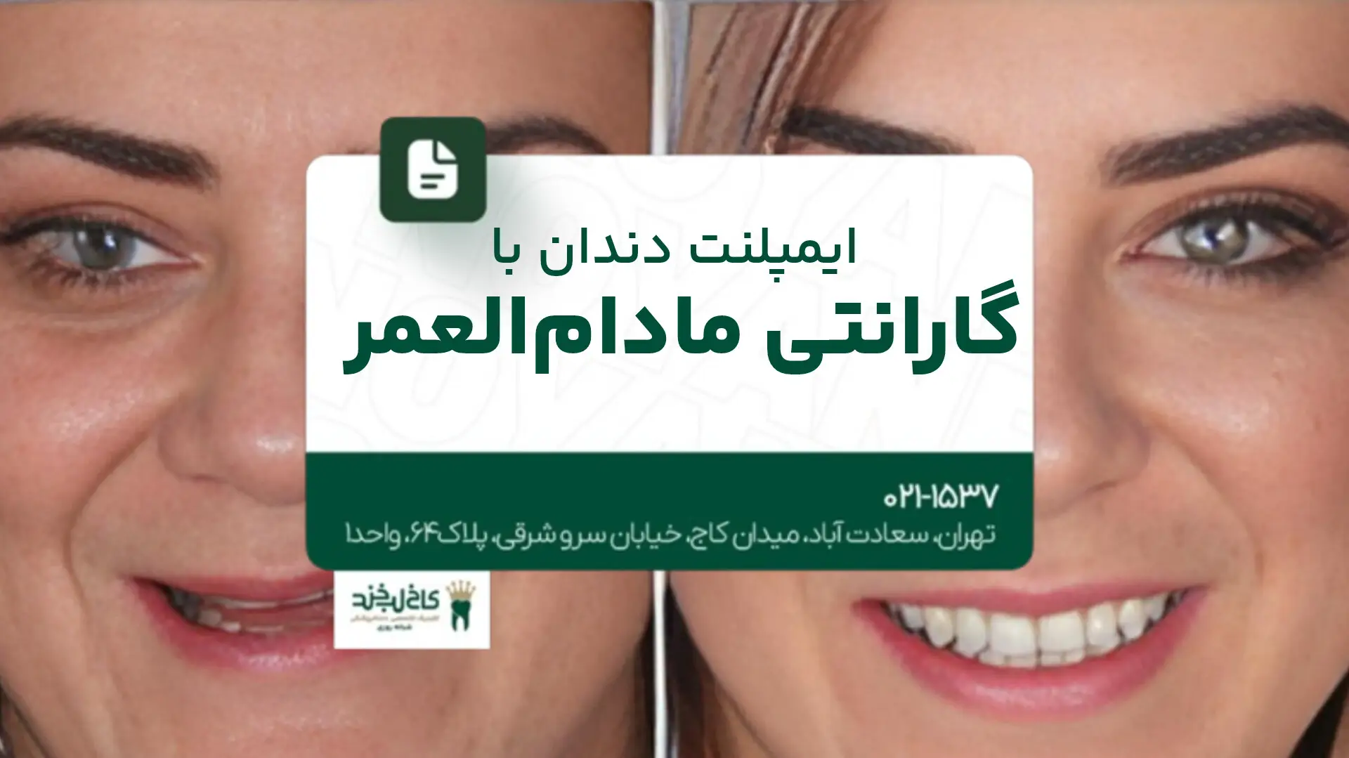 ایمپلنت دندان با گارانتی مادامالعمر