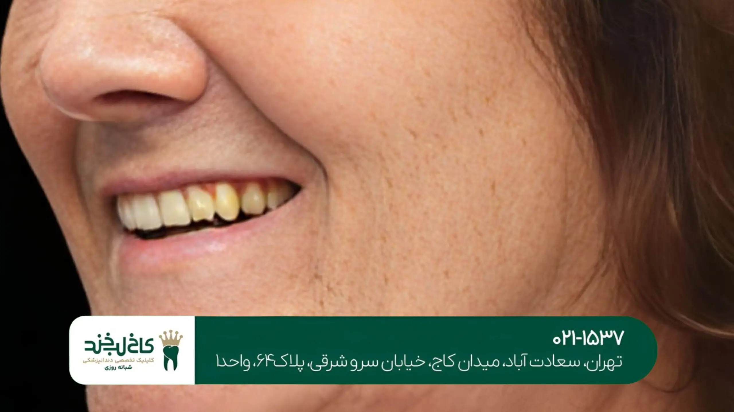 ایمپلنت دندان با گارانتی مادامالعمر