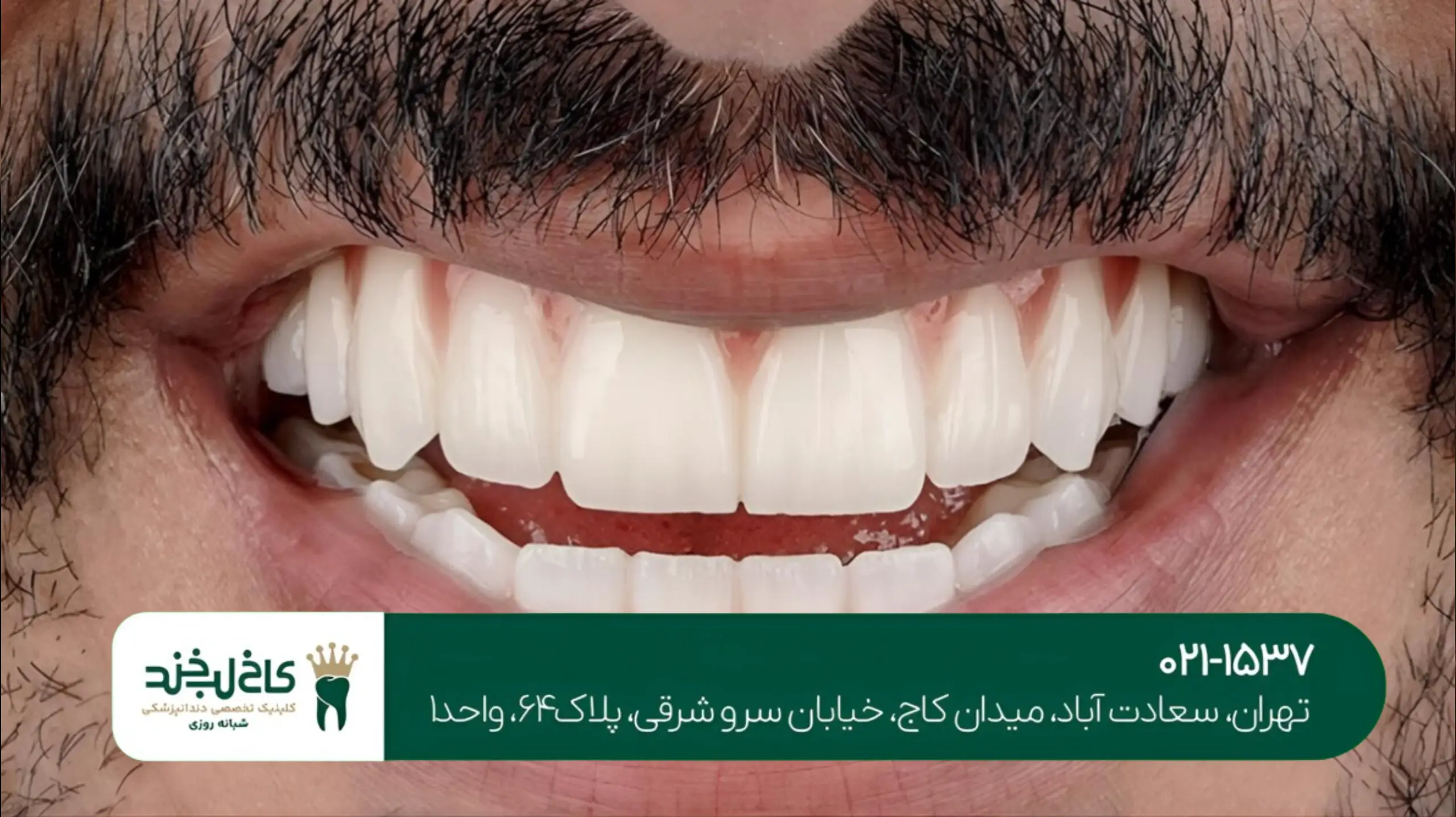 ایمپلنت دندان با گارانتی مادامالعمر