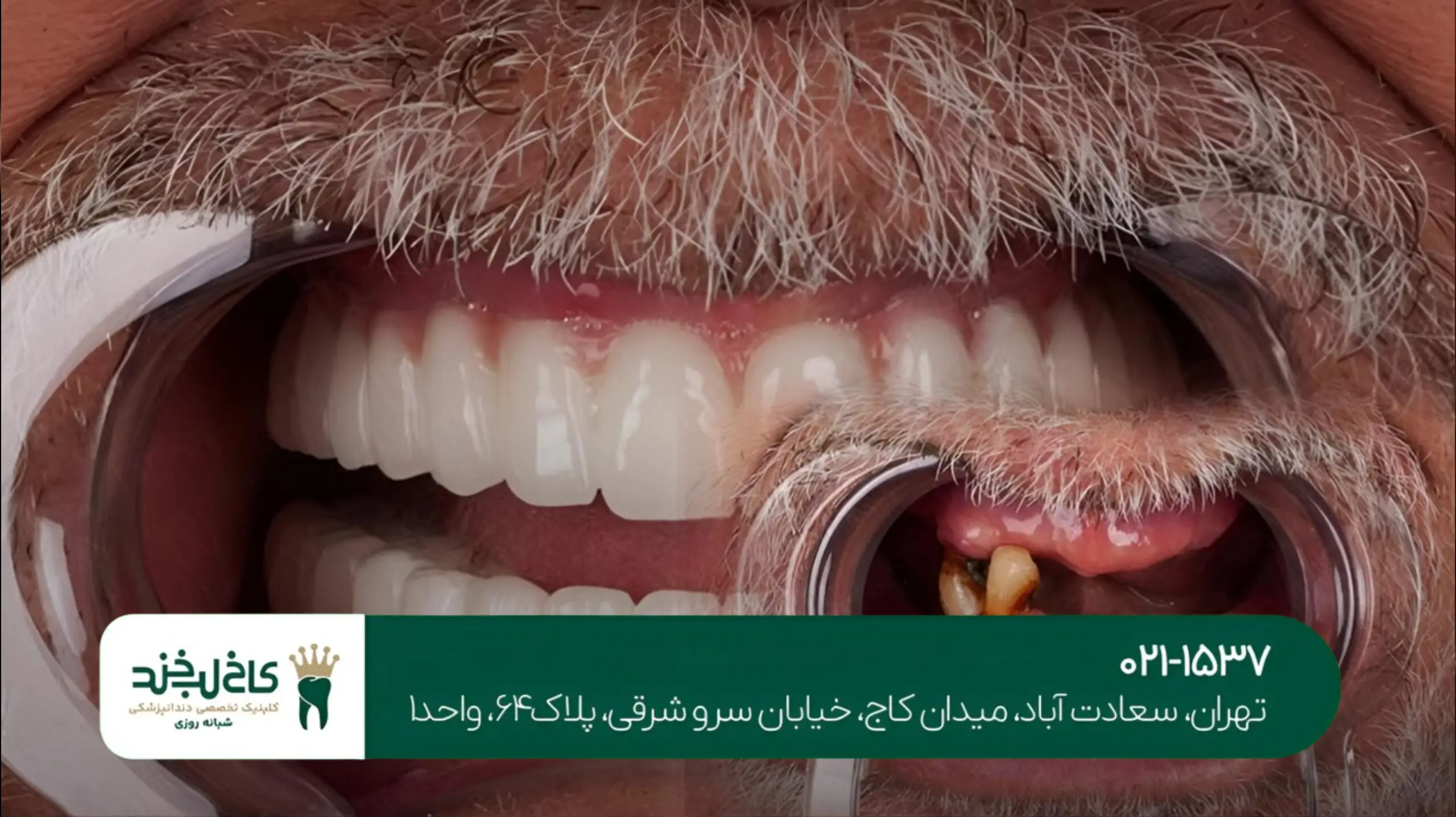 ایمپلنت دندان با گارانتی مادامالعمر