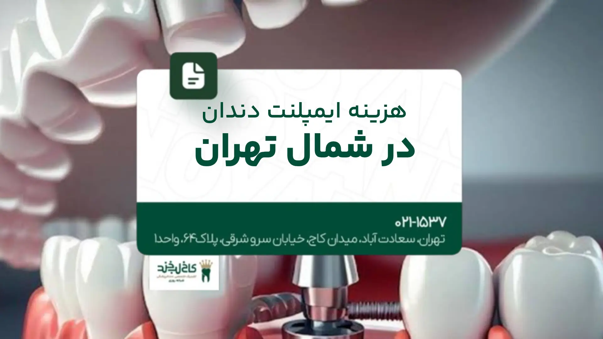 هزینه ایمپلنت دندان در شمال تهران