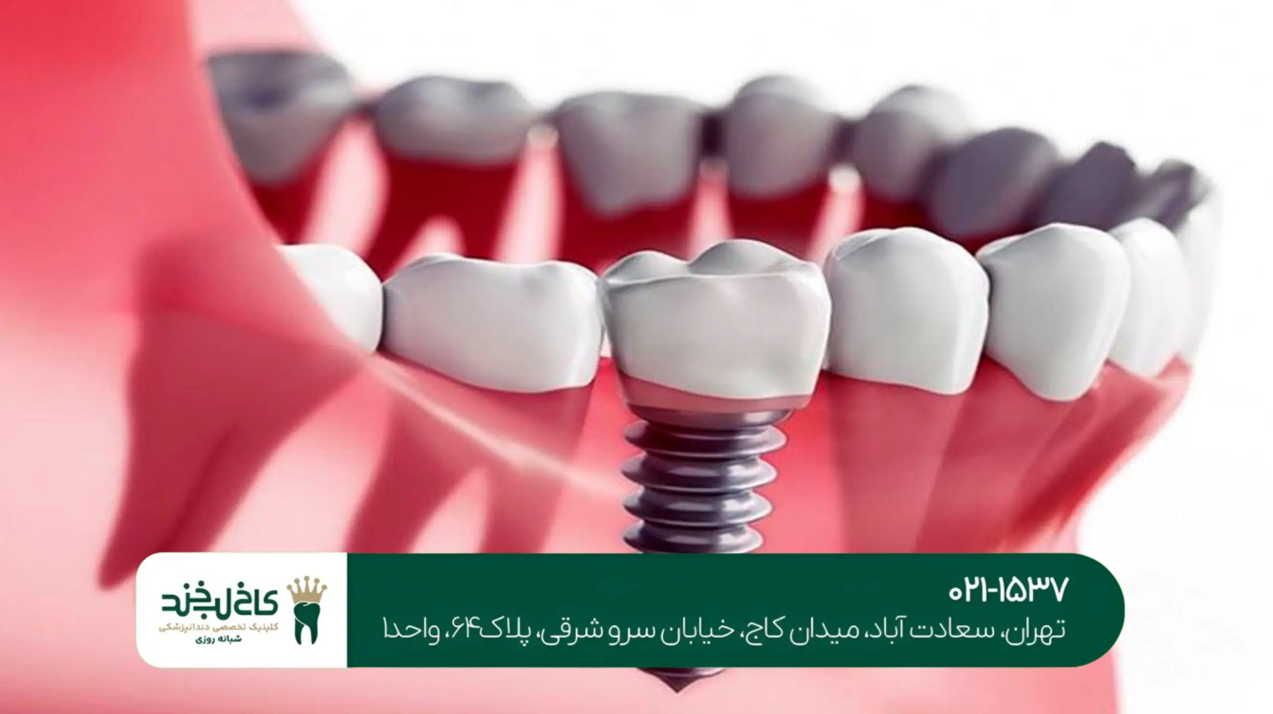 هزینه ایمپلنت دندان در شمال تهران