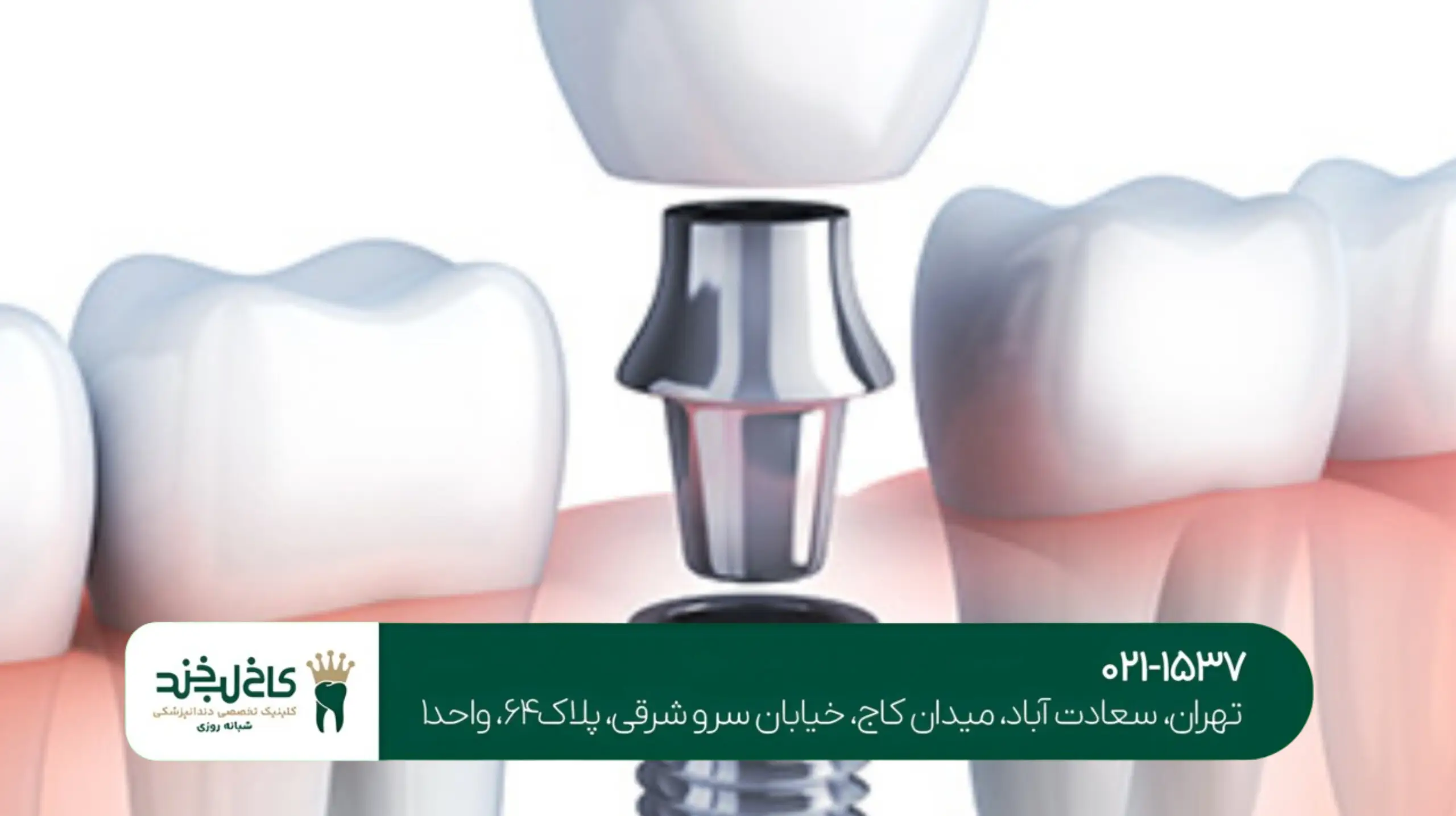هزینه ایمپلنت دندان در شمال تهران