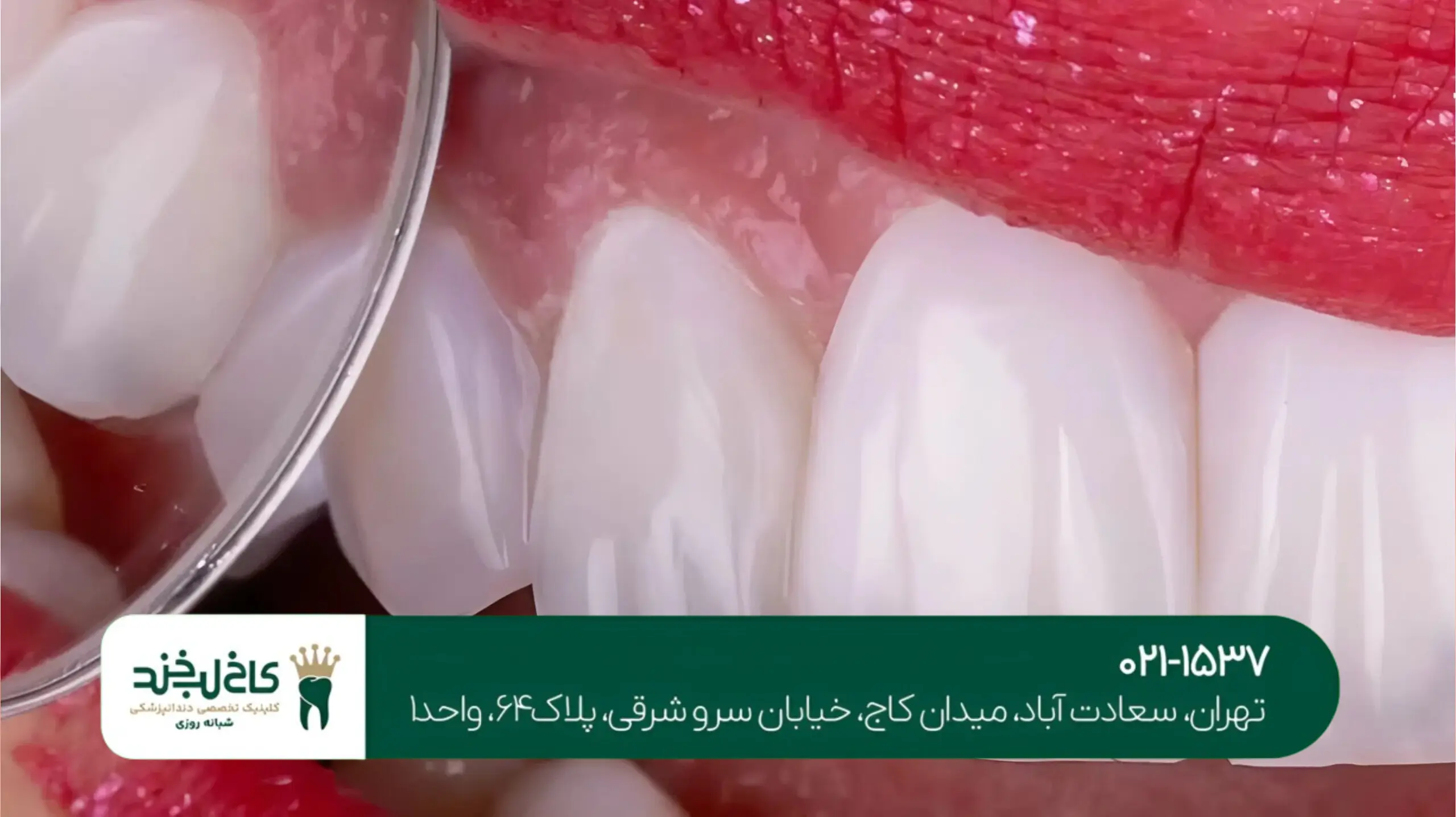 دندانپزشکی زیبایی در شمال تهران