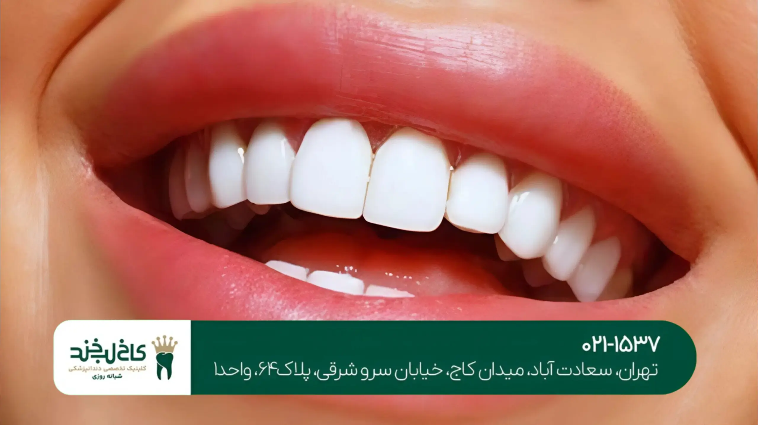 دندانپزشکی زیبایی در شمال تهران