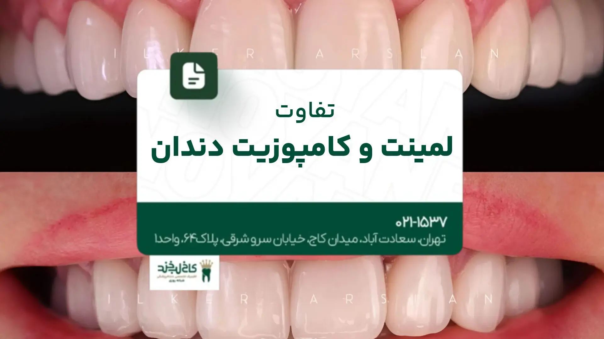 تفاوت لمینت و کامپوزیت دندان