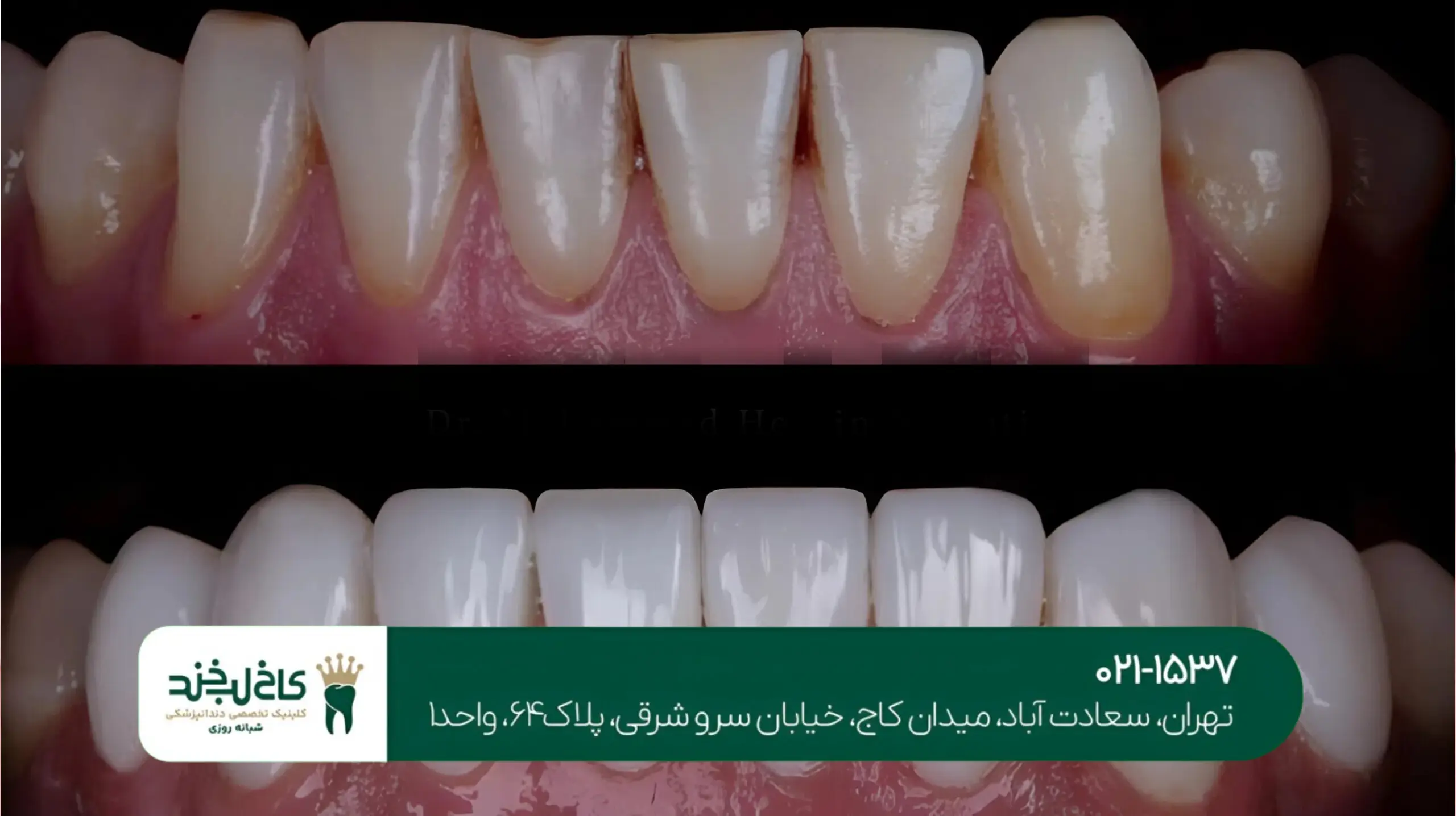 تفاوت لمینت و کامپوزیت دندان