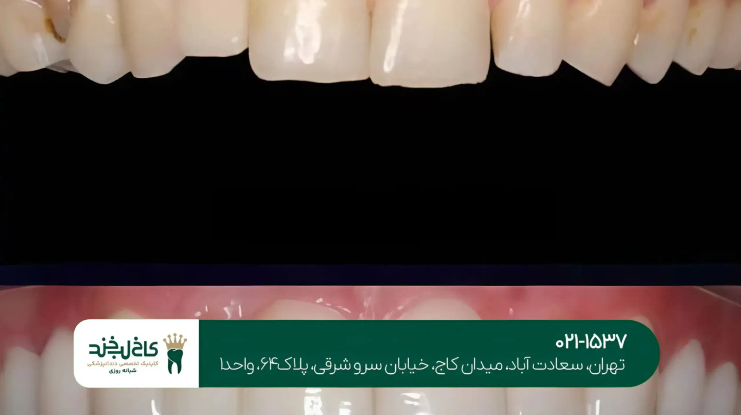 تفاوت لمینت و کامپوزیت دندان