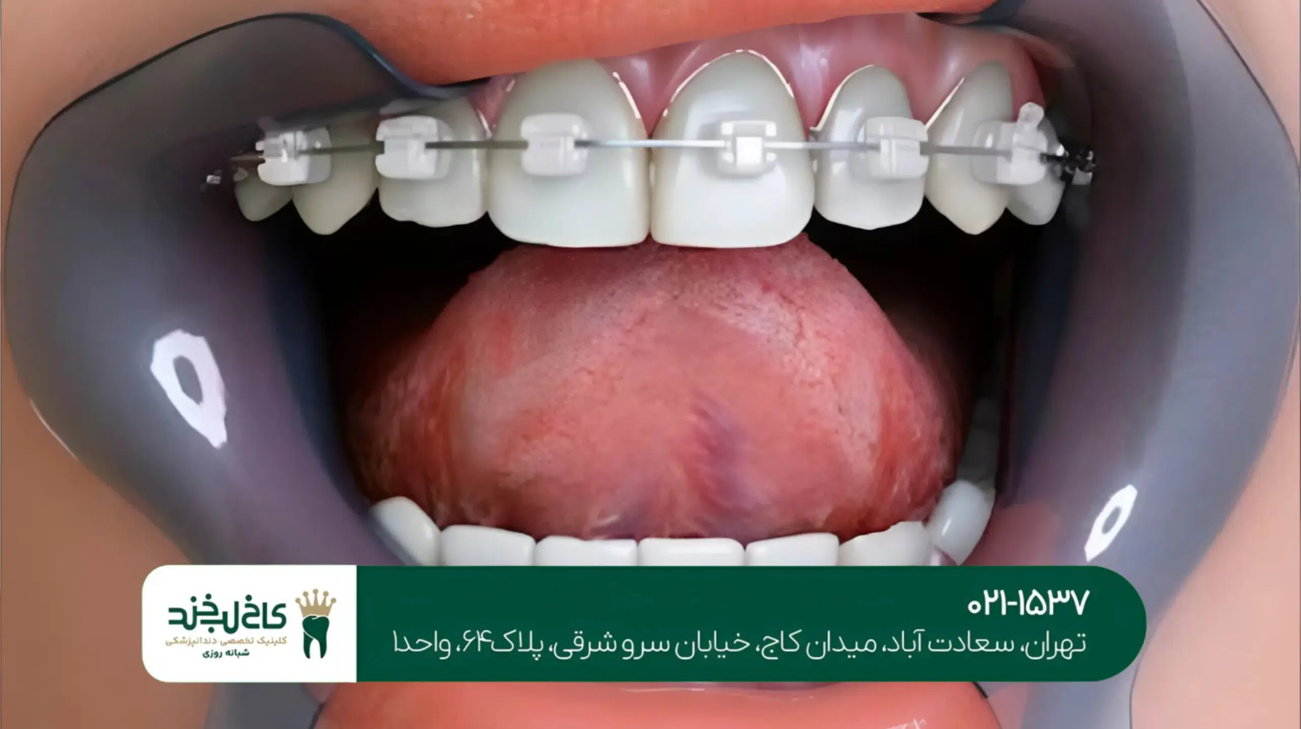 تفاوت لمینت و کامپوزیت دندان