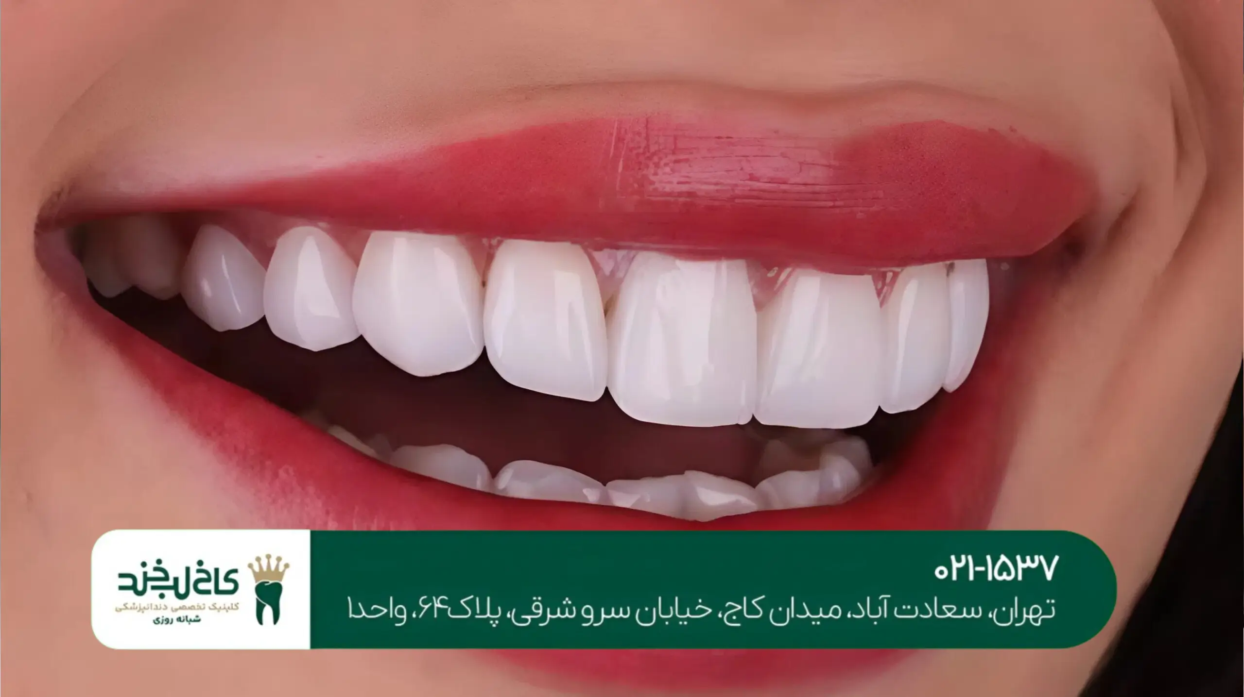 بهترین روش اصلاح طرح لبخند